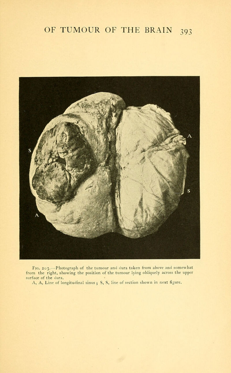 Fig. 203.—Photograph of the tumour and dura taken from above and somewhat from the right, showing the position of the tumour lying obliquely across the upper surface of the dura. A, A, Line of longitudinal sinus ; S, S, line of section shown in next figure.