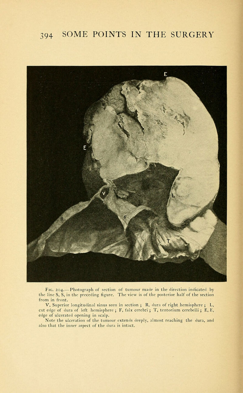 Fig. 204.—Photograph of section of tumour made in the direction indicated by the line S, S, in the preceding figure. The view is of the posterior half of the section from in front. V, Superior longitudinal sinus seen in section ; R, dura of right hemisphere ; L, cut edge of dura of left hemisphere ; F, falx cerebri ; T, tentorium cerebelli ; E, E, edge of ulcerated opening in scalp. Note the ulceration of the tumour extends deeply, almost reaching the dura, and also that the inner aspect of the ikira is intact.