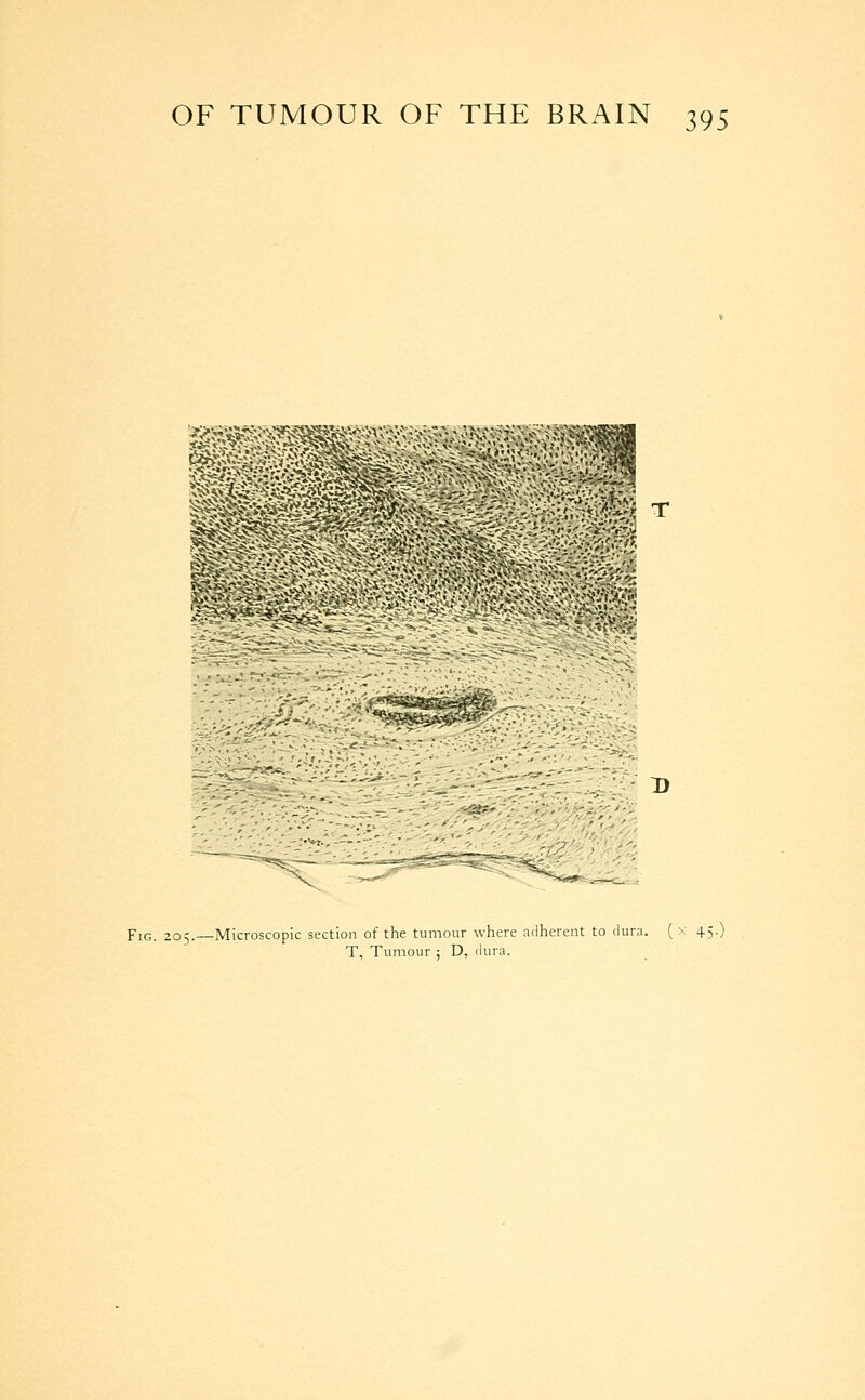 *^'«SAfo„\-«' n Fig. 205.—Microscopic section of the tumour where adherent to dura. ( x 45.) T, Tumour ; D, dura.
