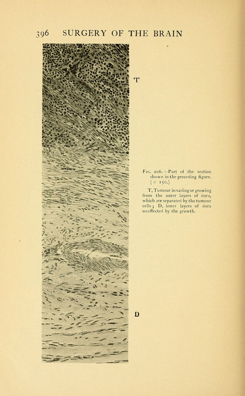 Fig. 206.—Part of the section shown in the preceding figure. (x 150.) T, Tumour invading or growing from the outer layers of dura, which are separated by the tumour cells ; D, inner layers of dura unaffected by the growth. D