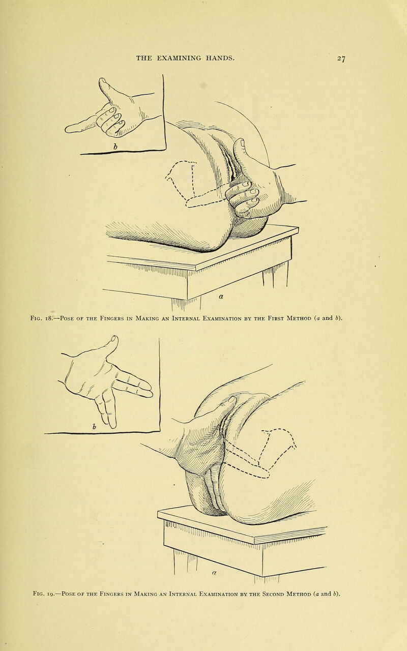 Fig. 18.—Pose of the Fingers in Making an Internal Examination by the First Method (a and b). Fig. 19.—Pose of the Fingers in Making an Internal Examination by the Second Method (o and 6).