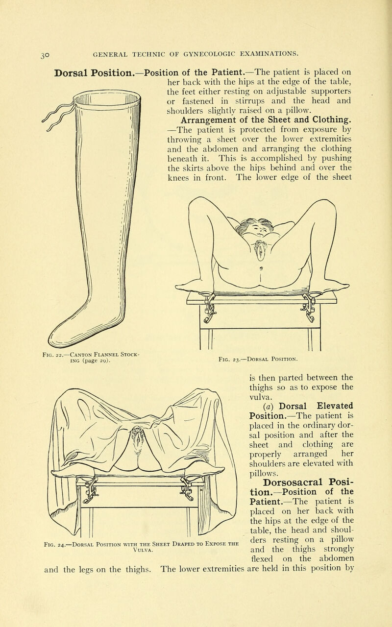 3° Dorsal Position. Position of the Patient.—The patient is placed on her back with the hips at the edge of the table, the feet either resting on adjustable supporters or fastened in stirrups and the head and shoulders slightly raised on a pillow. Arrangement of the Sheet and Clothing. —The patient is protected from exposure by throwing a sheet over the lower extremities and the abdomen and arranging the clothing beneath it. This is accomplished by pushing the skirts above the hips behind and over the knees in front. The lower edge of the sheet Fig. 22. -Canton Flannel Stock- ing (page 29). Fig. 23.—Dorsal Position. is then parted between the thighs so as to expose the vulva. (a) Dorsal Elevated Position.—The patient is placed in the ordinary dor- sal position and after the sheet and clothing are properly arranged her shoulders are elevated with pillows. Dorsosacral Posi- tion.—Position of the Patient.—The patient is placed on her back with the hips at the edge of the table, the head and shoul- ders resting on a pillow Fig. 24.—Dorsal Position with the Sheet Draped to Expose the , . , 1 Vulva. and the thighs strongly flexed on the abdomen and the legs on the thighs. The lower extremities are held in this position by
