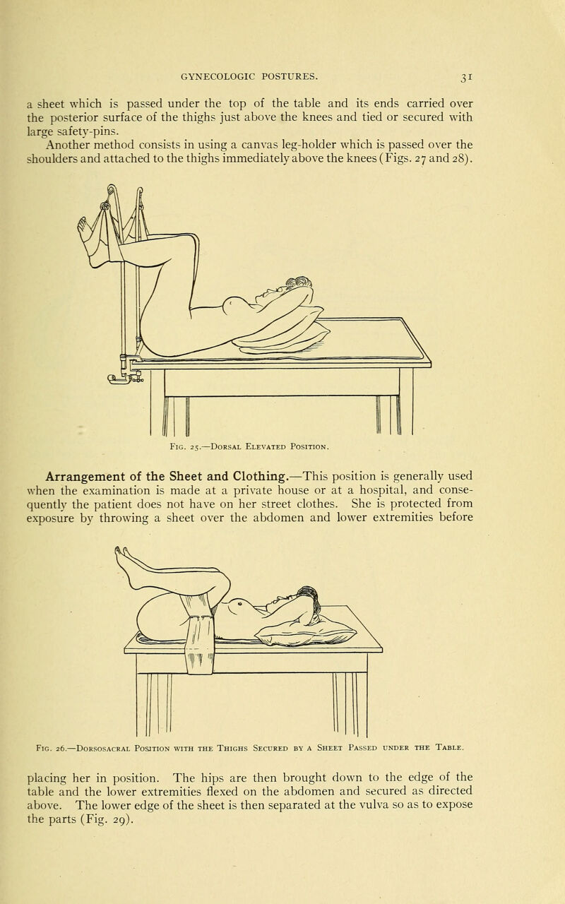 a sheet which is passed under the top of the table and its ends carried over the posterior surface of the thighs just above the knees and tied or secured with large safety-pins. Another method consists in using a canvas leg-holder which is passed over the shoulders and attached to the thighs immediately above the knees(Figs. 27 and 28). Fig. 25.—Dorsal Elevated Position. Arrangement of the Sheet and Clothing.—This position is generally used when the examination is made at a private house or at a hospital, and conse- quently the patient does not have on her street clothes. She is protected from exposure by throwing a sheet over the abdomen and lower extremities before Fig. 26.—Dorsosacral Position with the Thighs Secured by a Sheet Passed under the Table. placing her in position. The hips are then brought down to the edge of the table and the lower extremities flexed on the abdomen and secured as directed above. The lower edge of the sheet is then separated at the vulva so as to expose the parts (Fig. 29).