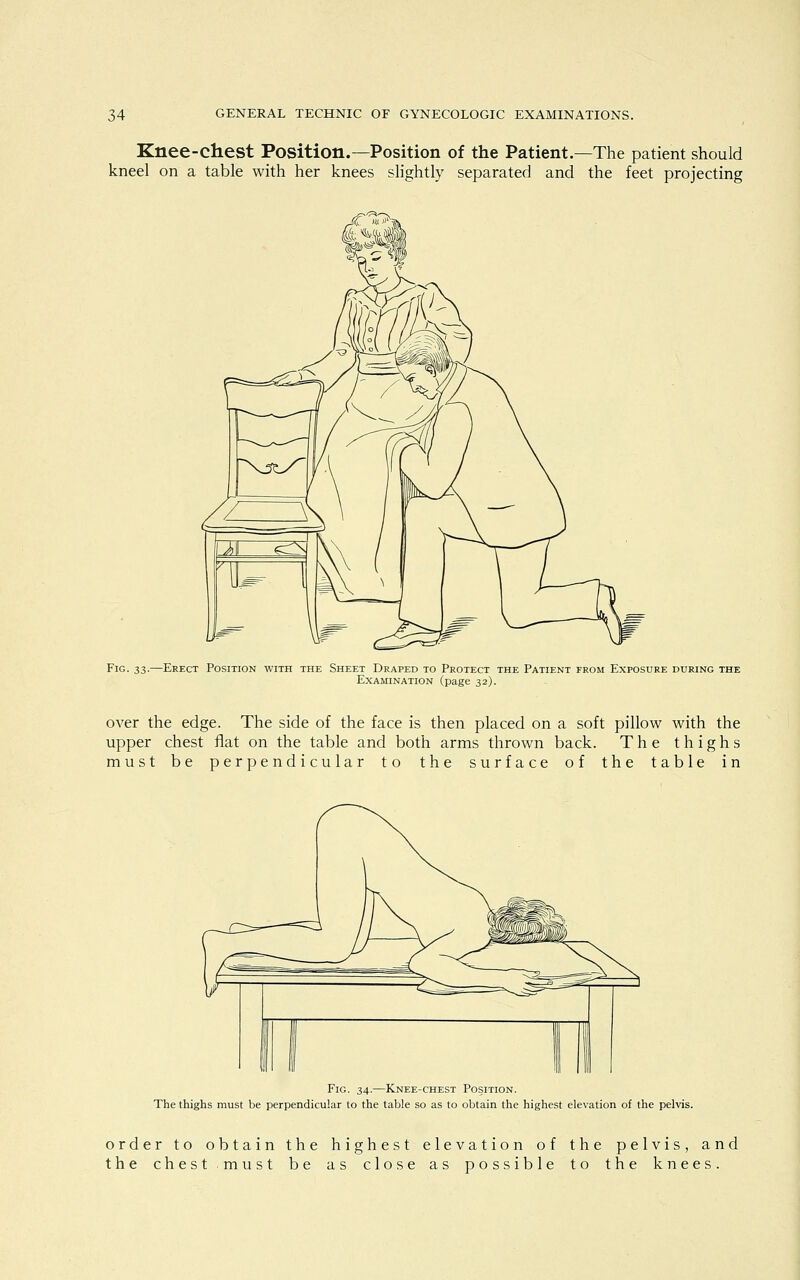 Knee-chest Position.—Position of the Patient.—The patient should kneel on a table with her knees slightly separated and the feet projecting Fig. 33.—Erect Position with the Sheet Draped to Protect the Patient from Exposure during the Examination (page 32). over the edge. The side of the face is then placed on a soft pillow with the upper chest flat on the table and both arms thrown back. The thighs must be perpendicular to the surface of the table in Fig. 34.—Knee-chest Position. The thighs must be perpendicular to the table so as to obtain the highest elevation of the pelvis. order to obtain the highest elevation of the pelvis, and the chest must be as close as possible to the knees.