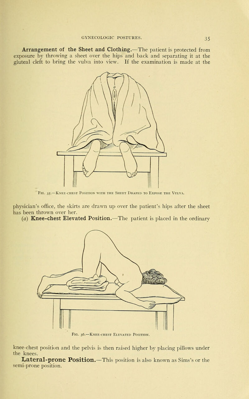 Arrangement of the Sheet and Clothing.—The patient is protected from exposure by throwing a sheet over the hips and back and separating it at the gluteal cleft to bring the vulva into view. If the examination is made at the Fig. 35.—Knee-chest Position with the Sheet Draped to Expose the Vulva. physician's office, the skirts are drawn up over the patient's hips after the sheet has been thrown over her. (a) Knee-chest Elevated Position.—The patient is placed in the ordinary Fig. 36.—Knee-chest Elevated Position. knee-chest position and the pelvis is then raised higher by placing pillows under the knees. I/ateral-prone Position.—This position is also known as Sims's or the semi-prone position.