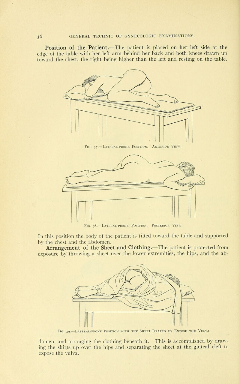 Position of the Patient.—The patient is placed on her' left side at the edge of the table with her left arm behind her back and both knees drawn up toward the chest, the right being higher than the left and resting on the table. Fig. 37.—Lateral-prone Position. Anterior View. Fig. 38.—Lateral-prone Position. Posterior View. In this position the body of the patient is tilted toward the table and supported by the chest and the abdomen. Arrangement of the Sheet and Clothing.—The patient is protected from exposure by throwing a sheet over the lower extremities, the hips, and the ab- Fig. 39.—Lateral-prone Position with the Sheet Draped to Expose the Vulva. domen, and arranging the clothing beneath it. This is accomplished by draw- ing the skirts up over the hips and separating the sheet at the gluteal cleft to expose the vulva.