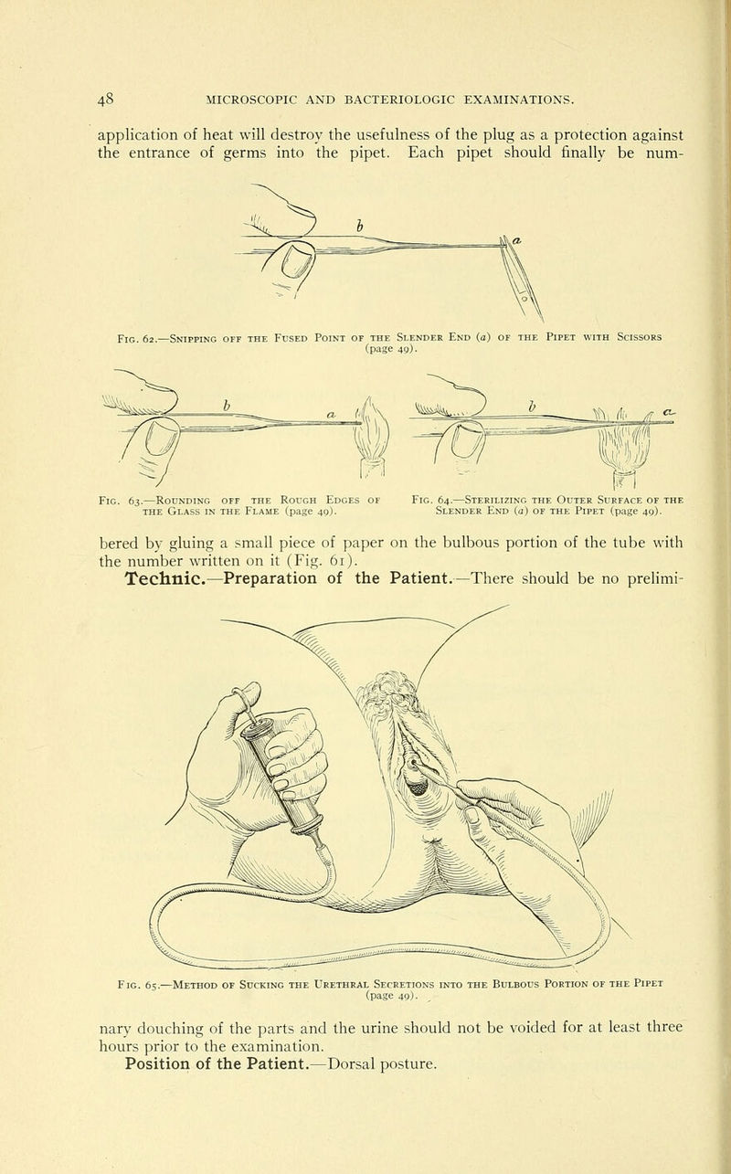 application of heat will destroy the usefulness of the plug as a protection against the entrance of germs into the pipet. Each pipet should finally be num- Fig. 62.—Snipping off the Fused Point of the Slender End (a) of the Pipet with Scissors (page 49) • Fig. 63.—Rounding off the Rough Edges of the Glass in the Flame (page 49). Fig. 64.—Sterilizing the Outer Surface of the Slender End (a) of the Pipet (page 49). bered by gluing a small piece of paper on the bulbous portion of the tube with the number written on it (Fig. 61). Technic.—Preparation of the Patient.—There should be no prelimi- Fig. 65.—Method of Sucking the Urethral Secretions into the Bulbous Portion of the Pipet (page 49). nary douching of the parts and the urine should not be voided for at least three hours prior to the examination. Position of the Patient.—Dorsal posture.