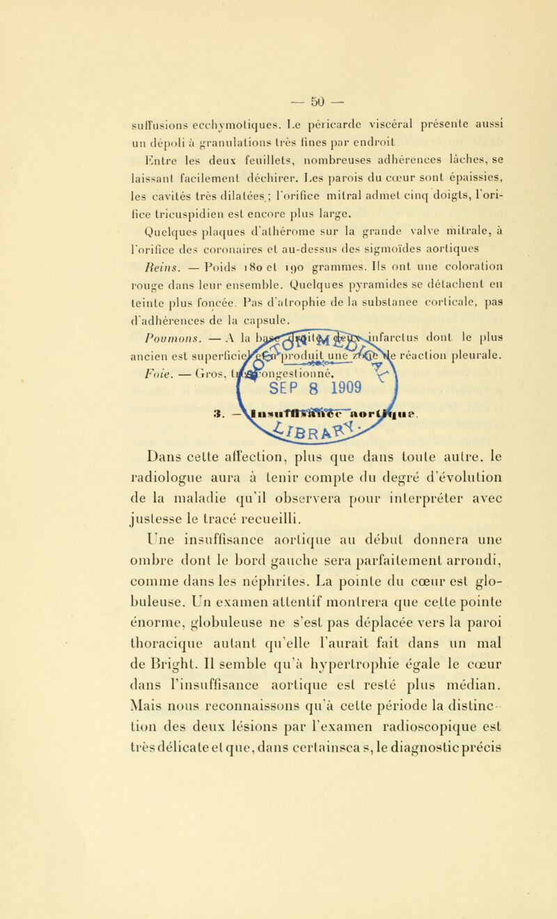 sufï'usions ecchymotiques. Le péricarde viscéral présente aussi un dépoli à granulations très fines par endroit Entre les deux feuillets, nombreuses adhérences lâches, se laissant facilement déchirer. Les parois du cœur sont épaissies, les cavités très dilatées.; l'orifice mitral admet cinq doigts, Lori- fice tficuspidien est encore plus large. Quelques plaques d'alhérome sur la grande valve mitrale, à l'orifice des coronaires et au-dessus des sigmoïdes aortiques Reins. —Poids 180 et 190 grammes. Ils ont une coloration rouge dans leur ensemble. Quelques pyramides se détachent en teinte plus foncée. Pas d'atrophie de la substance corticale, pas d'adhérences de la capsule, Poumons. — A la ba><rj4|*$it^( Sejl^nfarclus dont le plus ancien est superficieV^yrpr o duit une yj&\e réaction pleurale, Foie. — Gros, t] Dans cette affection, plus que dans toute autre, le radiologue aura à tenir compte du degré d'évolution de la maladie qu'il observera pour interpréter avec justesse le tracé recueilli. Une insuffisance aortique au début donnera une ombre dont le bord gauche sera parfaitement arrondi, comme dans les néphrites. La pointe du cœur est glo- buleuse. Un examen attentif montrera que cette pointe énorme, globuleuse ne s'est pas déplacée vers la paroi thoracique autant qu'elle l'aurait fait dans un mal de Bright. Il semble qu'à hypertrophie égale le cœur dans l'insuffisance aortique est resté plus médian. Mais nous reconnaissons qu'à cette période la distinc lion des deux lésions par l'examen radioscopique est très délicate et que, dans certainsca s, le diagnostic précis