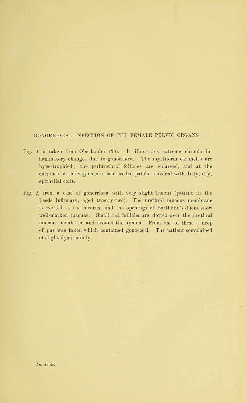 GONORRHEAL INFECTION OF THE FEMALE PELVIC ORGANS Fig. 1 is taken from Oberlander (38). It illustrates extreme chronic in- flammatory changes due to gonorrhoea. The myrtiform caruncles are hypertrophied ; the periurethral follicles are enlarged, and at the entrance of the vagina are seen eroded patches covered with dirty, dry, epithelial cells. Fig. 2, from a case of gonorrhoea with very slight lesions (patient in the Leeds Infirmary, aged twenty-two). The urethral mucous membrane is everted at the meatus, and the openings of Bartholin's ducts show well-marked maculre. Small red follicles are dotted over the urethral mucous membrane and around the hymen. From one of these a drop of pus was taken which contained gonococci. The patient complained of slight dysuria only. For Plate.