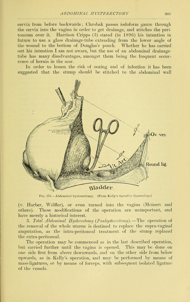 cervix from before backwards; Chrobak passes iodoform gauze through the cervix into the vagina in order to get drainage, and stitches the peri- toneum over it. Harrison Cripps (3) stated (in 1896) his intention in future to use. a glass drainage-tube extending from the lower angle of the wound to the bottom of Douglas's pouch. Whether he has carried out his intention I am not aware, but the use of an abdominal drainage- tube has many disadvantages, amongst them being the frequent occur- rence of hernia in the scar. In order to lessen the risk of oozing and of infection it has been suggested that the stump should be stitched to the abdominal wall Ov ves. gladder. Fig. 276.—Abdominal hysterectomy. (From Kelly's Operative Gyncecology.) (v. Harber, Wolfler), or even turned into the vagina (Meinert and others). These modifications of the operation are unimportant, and have merely a historical interest. 3. Total Abdominal Hysterectomy {Panhysterectomy).—The operation of the removal of the whole uterus is destined to replace the supra-vaginal amputation, as the intra-peritoneal treatment of the stump replaced the extra-peritoneal. The operation may be commenced as in the last described operation, but carried further until the vagina is opened. This may be done on one side first from above downwards, and on the other side from below upwards, as in Kelly's operation, and may be performed by means of mass-ligatures, or by means of forceps, with subsequent isolated ligature of the vessels.