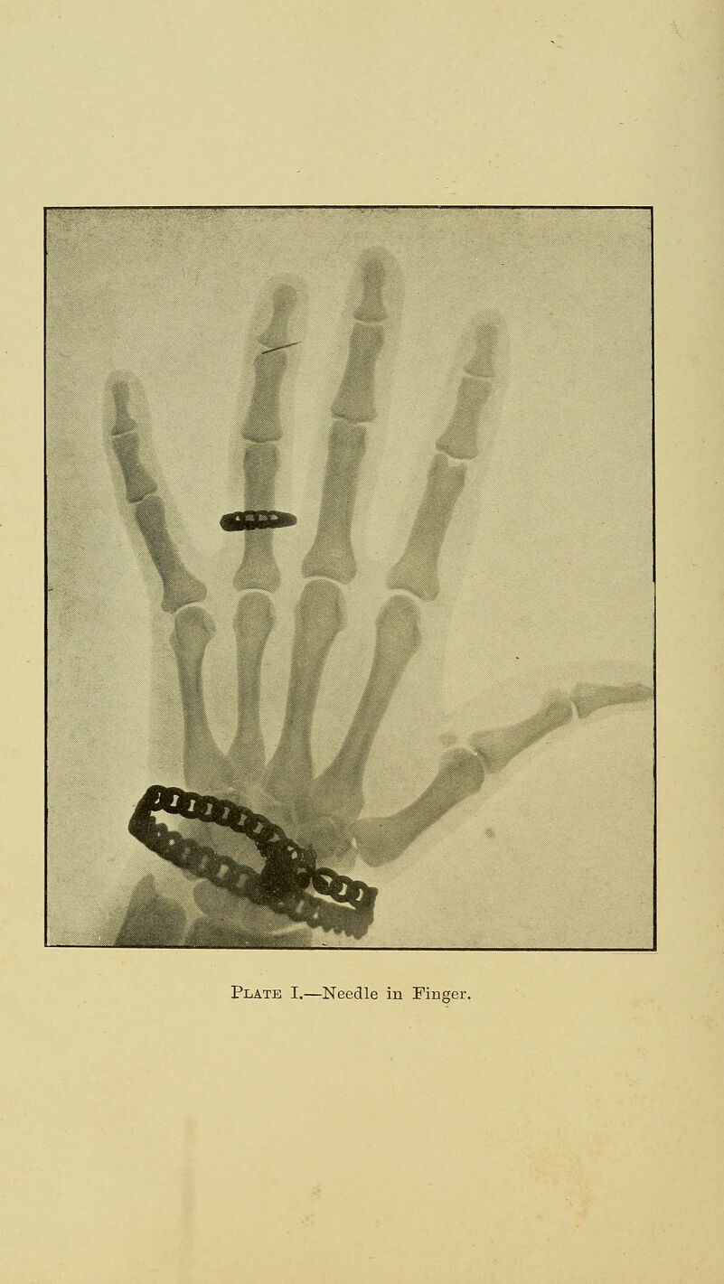 Plate I.—Needle in Finger.