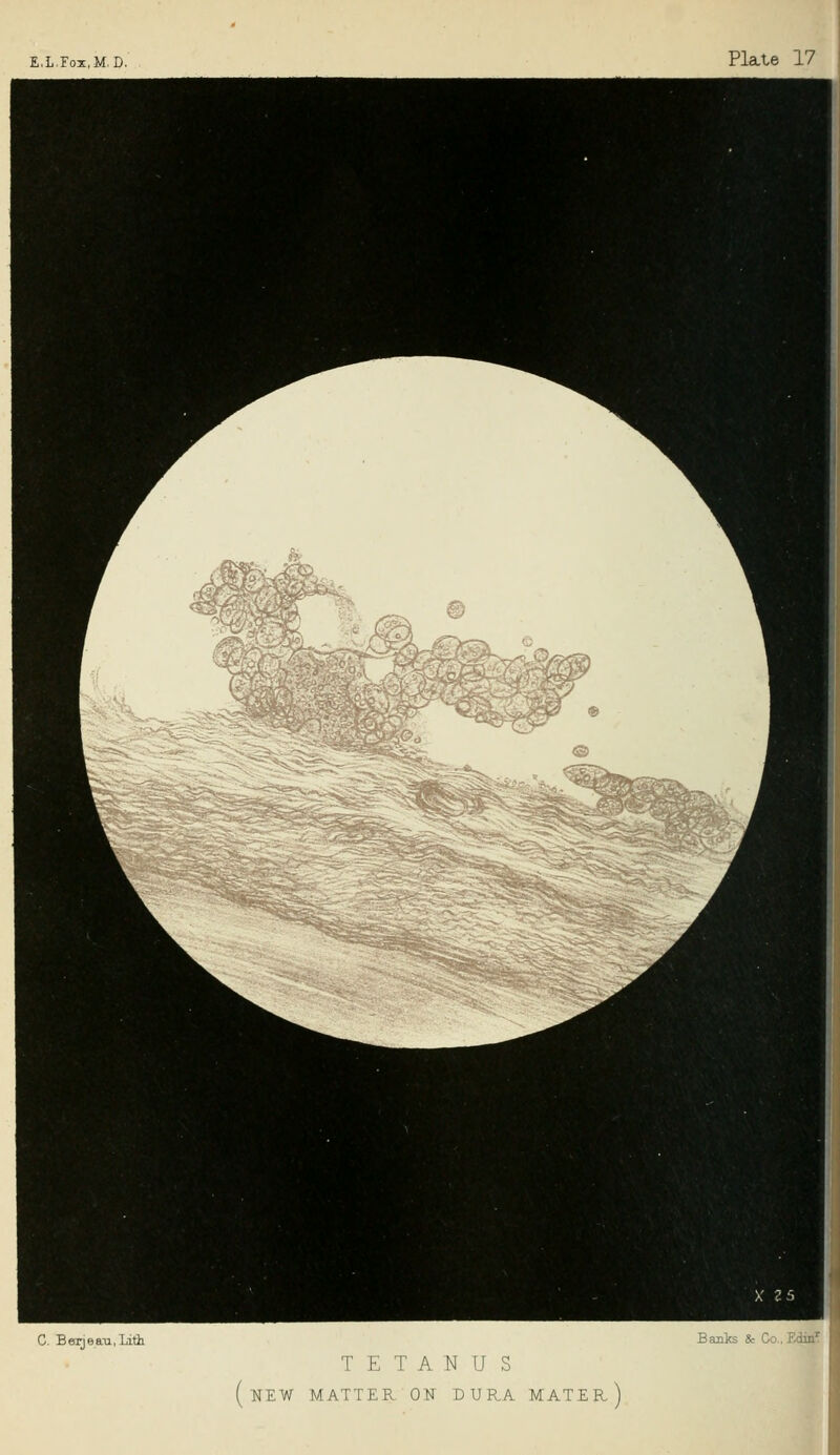 C. BerjeaTi.Lith Banks & Co., TETANUS (new matter on dura mater.