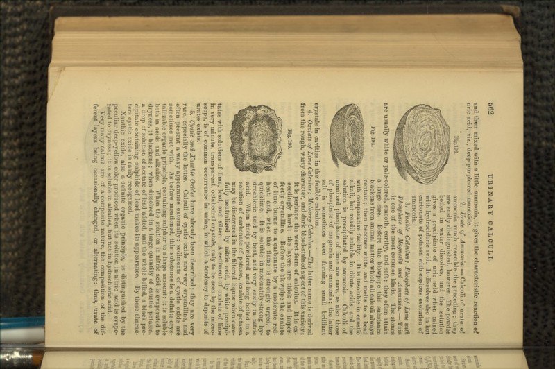 062 URINARY CALCULI. and then mixed witn a little ammonia, it gives the characteristic reaction of uric acid, viz., deep purple-red murexide. 2. Urate of Ammonia. — Calculi of urate of Vi;_'.l93. ammonia much resemble the preceding; they are easily distinguished, however. The powder boiled in water dissolves, and the solution gives a precipitate of uric acid when mixed with hydrochloric acid. It dissolves also in hot carbonate of potassa with copious evolution of ammonia. 3. Fusible Calculus; Phosphate of Lime with Phosphate of Magnesia and Ammonia. — This is one of the most common kinds. The stones are usually white or pale-colored, smooth, earthy, and soft; they often attain a large size. Before the blowpipe this substance Fig. 194. blackens from animal matter which all calculi always contain; then becomes white, and melts to a bead with comparative facility. It is insoluble in caustic alkali, but readily soluble in dilute acids, and the solution is precipitated by ammonia. Calculi of unmixed phosphate of lime are rare, as also those of phosphate of magnesia and ammonia; the latter salt is sometimes seen forming small brilliant crystals in cavities in the fusible calculus. 4. Oxalate of Lime Calculus; Mulberry Calculus.—The latter name is derived from the rough, warty character, and dark blood-stained aspect of this variety; it is perhaps the worst form of calculus. It is ex- ceedingly hard; the layers are thick and imper- fectly crystalline. Before the blowpipe the oxalate of lime burns to a carbonate by a moderate red- heat, and, when the flame is strongly urged, to quicklime. It is soluble in moderately-strong hy- drochloric acid by heat, and very easily in nitric acid. When finely powdei-ed and long boiled in a solution of carbonate of potassa, oxalate of pota>s:i may be discovered in the filtered liquor when care- fully neutralized by nitric acid, by white precipi- tates with solutions of lime, lead, and silver. A sediment of oxalate of lime in very minute, transparent, octahedral crystals, only to be seen by the micro- scope, is of common occurrence in urine, in which a tendency to deposits of urates exists. rare, especially the latter. Calculi of cystic oxide aro very crystalline, and often present a waxy appearance externally: sediments of cystic oxide are sometimes met with. As before mentioned, this substance is a definite crys- tallizable organic principle, containing sulphur to a large amount; it is soluble both in acids and alkalies. When the solution in nitric acid is evaporated to dryness, it blackens; when dissolved in a large quantity of caustic potassa, a drop of solution of acetate of lead added, and the whole boiled, a black pre- cipitate containing sulphide of lead makes its appearance. By these charac- ters cystic oxide is easily recognised. Xauthic oxide, also a definite organic principle, is distinguished by tho peculiar deep-yellow color produced when its solution in nitric acid is evapo- ruti-d to dryness; it is soluble in alkalies, but not in hydrochloric acid. V.TV iiuiuy calculr are of a composite nature, the composition of the dif- ferent layers being occasionally changed, or alternating: thus, urate of Fig. 195.