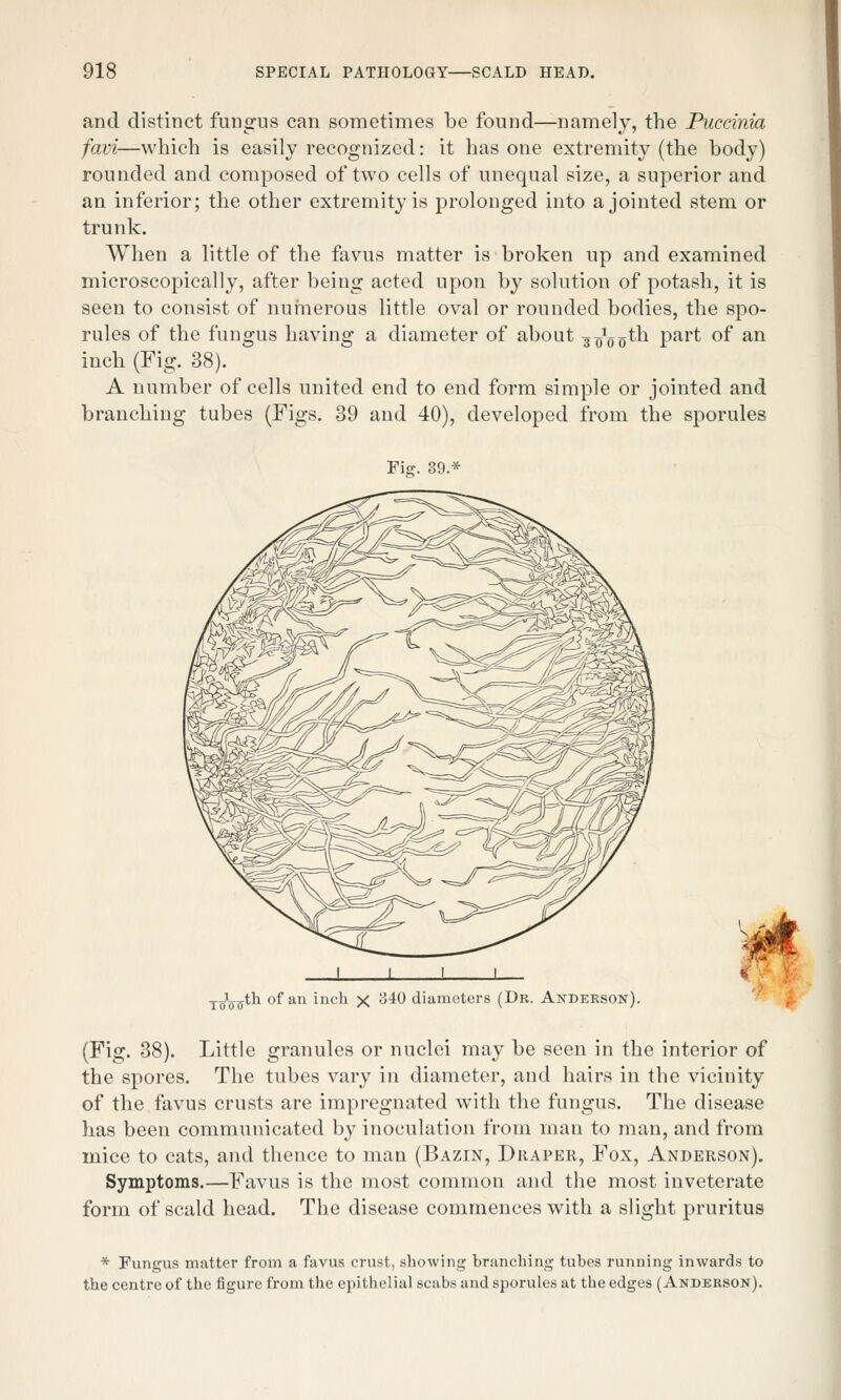 and distinct fungus can sometimes be found—namely, the Puccinia favi—which is easily recognized: it has one extremity (the body) rounded and composed of two cells of unequal size, a superior and an inferior; the other extremity is prolonged into a jointed stem or trunk. When a little of the favus matter is broken up and examined microscopically, after being acted upon by solution of potash, it is seen to consist of numerous little oval or rounded bodies, the spo- rules of the fungus having a diameter of about jJ^jth part of an inch (Fig. 38). A number of cells united end to end form simple or jointed and branching tubes (Figs. 39 and 40), developed from the sporules .jJL^th of an inch x 340 diameters (Dr. Anderson). (Fig. 38). Little granules or nuclei may be seen in the interior of the spores. The tubes vary in diameter, and hairs in the vicinity of the favus crusts are impregnated with the fungus. The disease has been communicated by inoculation from man to man, and from mice to cats, and thence to man (Bazin, Draper, Fox, Anderson). Symptoms.—Favus is the most common and the most inveterate form of scald head. The disease commences with a slight pruritus * Fungus matter from a favus crust, showing branching tubes running inwards to the centre of the figure from the epithelial scabs and sporules at the edges (Anderson).