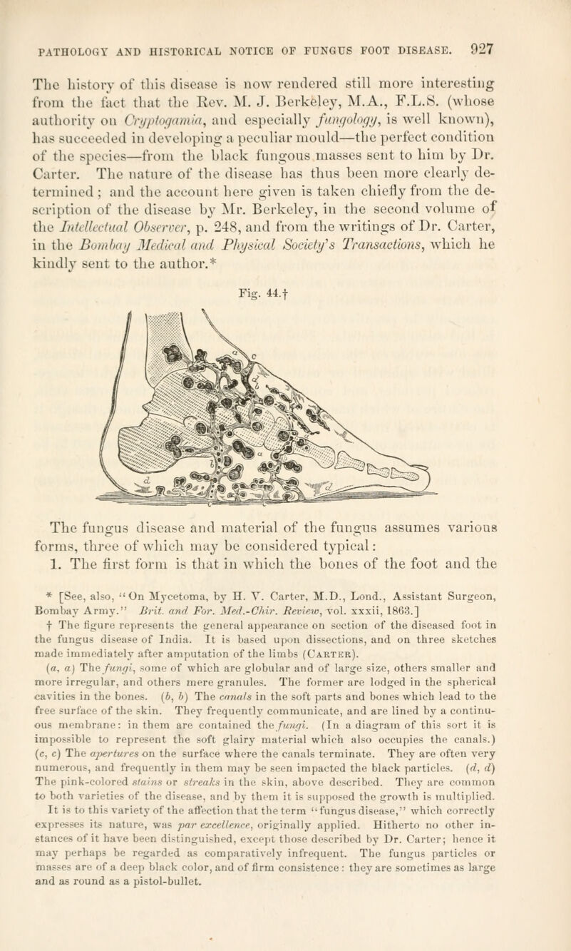 The history of this disease is now rendered still more interesting from the feci that the Rev. M. J. Berkeley, M.A., F.L.S. (whose authority on Qryptogamia, and especially fungology, is well known), has succeeded in developing a peculiar mould—the perfect condition of the species—from the black fungous masses sent to him by Dr. Carter. The nature of the disease has thus been more clearly de- termined ; and the account here given is taken chiefly from the de- scription of the disease by Mr. Berkeley, in the second volume of the Intellectual Observer, p. 248, and from the writings of Dr. Carter, in the Bombay Medical and Physical Society's Transactions, which he kindly sent to the author.* Fig. 44.f The fungus disease and material of the fungus assumes various forms, three of which may be considered typical: 1. The first form is that in which the bones of the foot and the * [See, also, On Mycetoma, by H. Y. Carter, M.D., Lond., Assistant Surgeon, Bombay Army. Brit, and For. Med.-Chir. Review, vol. xxxii, 1863.] f The figure represents the general appearance on section of the diseased foot in tbe fungus disease of India. It is based upon dissections, and on three sketches made immediately after amputation of the limbs (Carter). (a, a) The fungi, some of which are globular and of large size, others smaller and more irregular, and others mere granules. The former are lodged in the spherical cavities in the bones. (b, b) The canals in the soft parts and bones which lead to the free surface of the skin. They frequently communicate, and are lined by a continu- ous membrane: in them are contained the fungi. (In a diagram of this sort it is impossible to represent the soft glairy material which also occupies the canals.) (c, c) The apertures on the surface where the canals terminate. They are often very numerous, and frequently in them may be seen impacted the black particles, (d, d) The pink-colored stains or streaks in the skin, above described. They are common to both varieties of the disease, and by them it is supposed the growth is multiplied. It is to this variety of the affection that the term fungus disease, which correctly expresses its nature, was par excellence, originally applied. Hitherto no other in- stances of it have been distinguished, except those described by Dr. Carter; hence it may perhaps be regarded as comparatively infrequent. The fungus particles or masses are of a deep black color, and of firm consistence : they are sometimes as large and as round as a pistol-bullet.