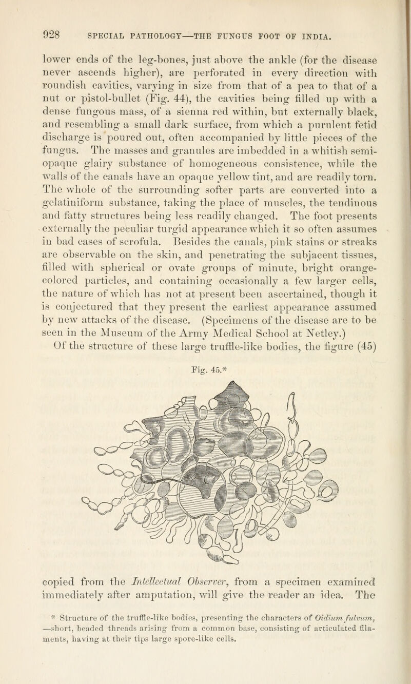 lower ends of the leg-bones, just above the ankle (for the disease never ascends higher), are perforated in every direction with roundish cavities, varying in size from that of a pea to that of a nut or pistol-bullet (Fig. 44), the cavities being tilled up with a dense fungous mass, of a sienna red within, but externally black, and resembling a small dark surface, from which a purulent fetid discharge is poured out, often accompanied by little pieces of the fungus. The masses and granules are imbedded in a whitish semi- opaque glairy substance of homogeneous consistence, while the walls of the canals have an opaque yellow tint, and are readily torn. The whole of the surrounding softer parts are converted into a gelatiniform substance, taking the place of muscles, the tendinous and fatty structures being less readily changed. The foot presents externally the peculiar turgid appearance which it so often assumes in bad cases of scrofula. Besides the canals, pink stains or streaks are observable on the skin, and penetrating the subjacent tissues, tilled with spherical or ovate groups of minute, bright orange- colored particles, and containing occasionally a few larger cells, the nature of which has not at present been ascertained, though it is conjectured that they present the earliest appearance assumed by new attacks of the disease. (Specimens of the disease are to be seen in the Museum of the Army Medical School at Netley.) Of the structure of these large trume-like bodies, the figure (45) Fig. 45.* copied from the Intellectual Observer, from a specimen examined immediately after amputation, will give the reader an idea. The * Structure of the truffle-like bodies, presenting the characters of Oidiurn fulmcm^ —short, headed threads arising from a common base, consisting of articulated fila- ments, having at their tips large spore-like cells.