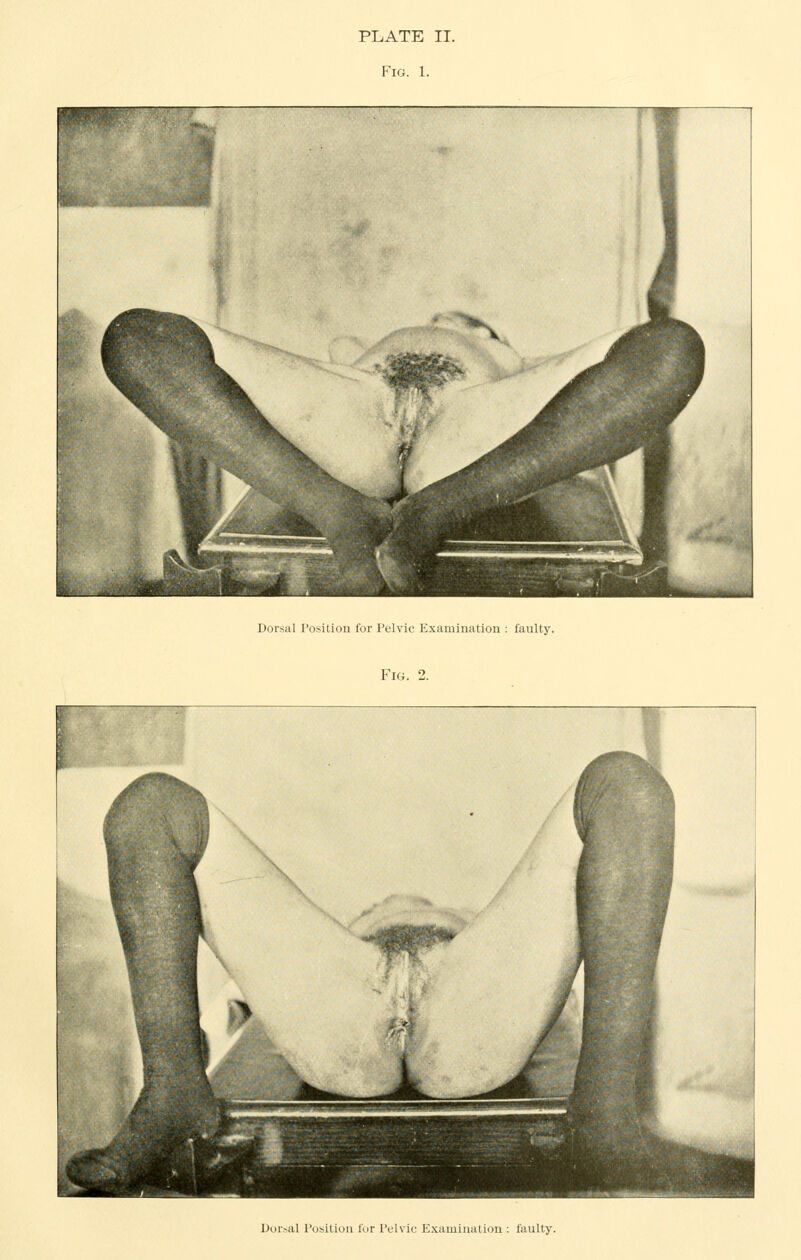 Fig. 1. Dorsal Position for Pelvic Examination : faulty. Fia. 2. Dor.^al Position lor Pelvic E.xamination : faulty.