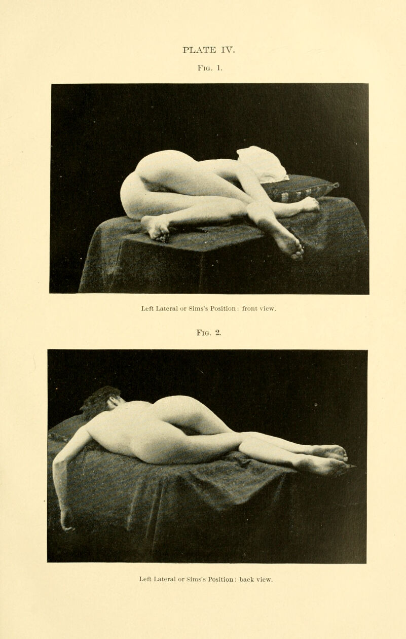 PLATE IV. Fig. 1. Left Lateral or Sims's Position: front view. Fig. 2. Left Lateral or Sims's Position: back view.