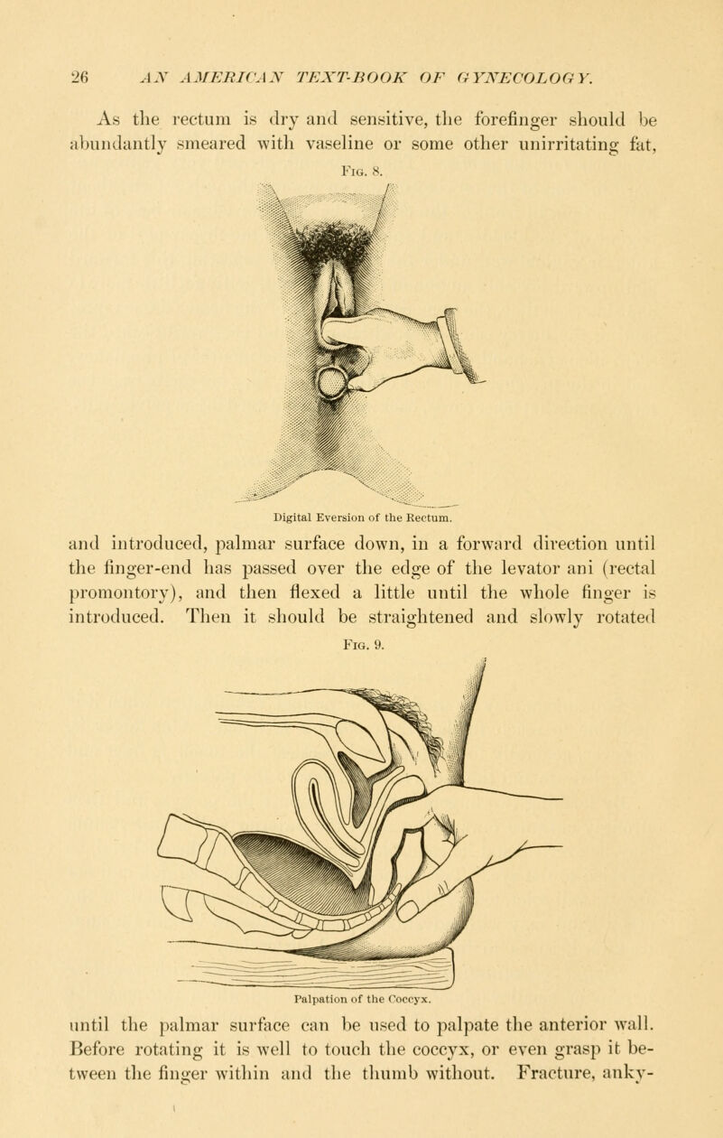 As the rectum is dry and sensitive, tlie forefinger should be abundantly smeared with vaseline or some other unirritating fat, Fig, 8. Digital Eversion of the Rectum. and introduced, palmar surface down, in a forward direction until the finger-end has passed over the edge of the levator ani (rectal promontory), and then flexed a little until the whole finger is introduced. Then it should be straightened and slowly rotated Fig. Palpation of the Coccyx. until the palmar surface can be used to palpate the anterior wall. Before rotating it is well to touch the coccyx, or even grasp it be- tween the finger within and the thumb without. Fracture, anky-