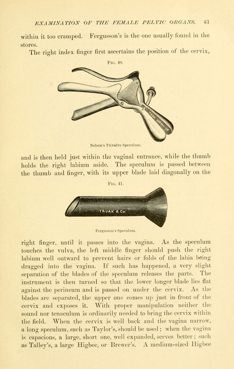 within it too cramped. Fergusson's is the one usually found in the stores. The rio-ht index finger first ascertains the position of the cervix, Fi(i. 4( Nelson's Trivalve Speculum. and is then held just within the vaginal entrance, while the thumb holds the right labium aside. The speculum is passed between the thumb and finger, with its upper blade laid diagonally on the Fig. 41. Fergusson's Speculum. right finger, until it passes into the vagina. As the speculum touches the vulva, the left middle finger should push the right labium well outward to prevent hairs or folds of the labia being dragged into the vagina. If such has happened, a very slight separation of the blades of the speculum releases the parts. The instrument is then turned so that the lower longer blade lies flat against the perineum and is passed on under the cervix. As the blades are separated, the upper one comes up just in front of the cervix and exposes it. With j^roper manipulation neither the sound nor tenaculum is ordinarily needed to bring the cervix within the field. AVhen the cervix is well back and the vagina narrow, a long speculum, such as Taylor's, should be used ; when the vagina is capacious, a large, short one, well expanded, serves better; such as Talley's, a large Higbee, or Brewer's. A medium-sized Higbee