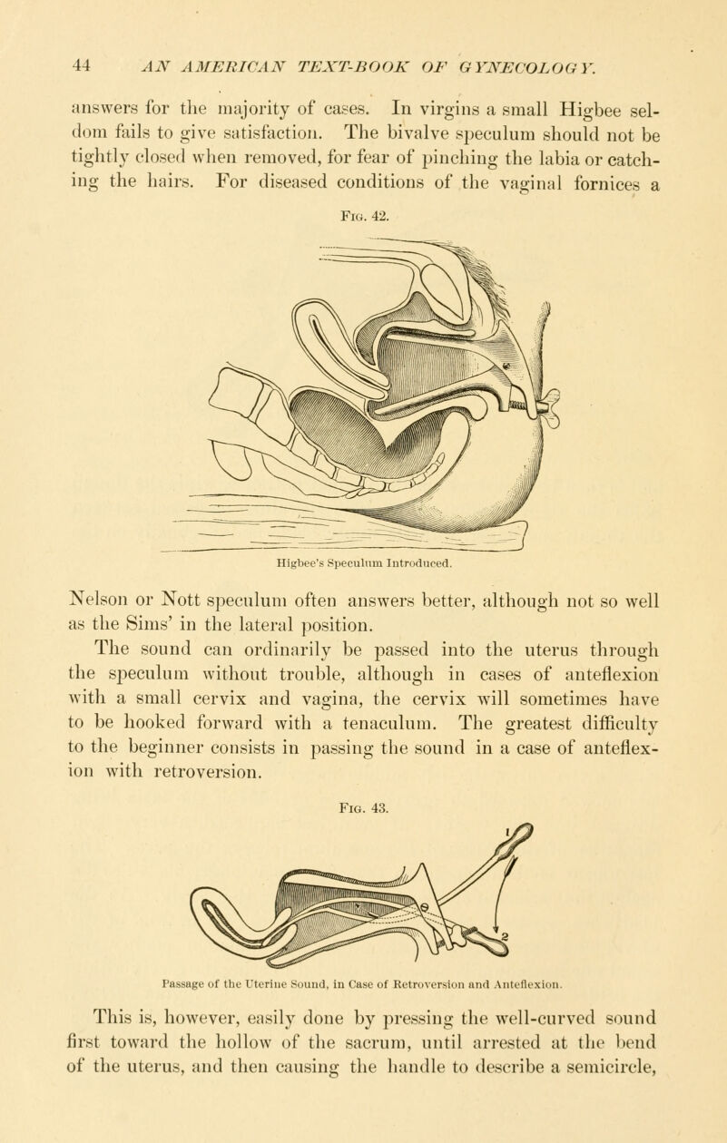 answers for the majority of cases. In virgins a small Higbee sel- dom fails to give satisfaction. The bivalve speculum should not be tightly closed when removed, for fear of pinching the labia or catch- ing the hairs. For diseased conditions of the vaginal fornices a Fig. 42. Higbee's Speculum Introduced. Nelson or Nott speculum often answers better, although not so well as the Sims' in the lateral position. The sound can ordinarily be passed into the uterus through the si^eculum without trouble, although in cases of anteflexion with a small cervix and vagina, the cervix will sometimes have to be hooked forward with a tenaculum. The greatest difficulty to the beginner consists in passing the sound in a case of anteflex- ion with retroversion. Fig. 43. Passage of the Uterine Sound, in Case of Retroversion and Anteflexion. This is, however, easily done by pressing the well-curved sound first toward the hollow of the sacrum, until arrested at the bend of the uterus, and then causing the handle to describe a semicircle,