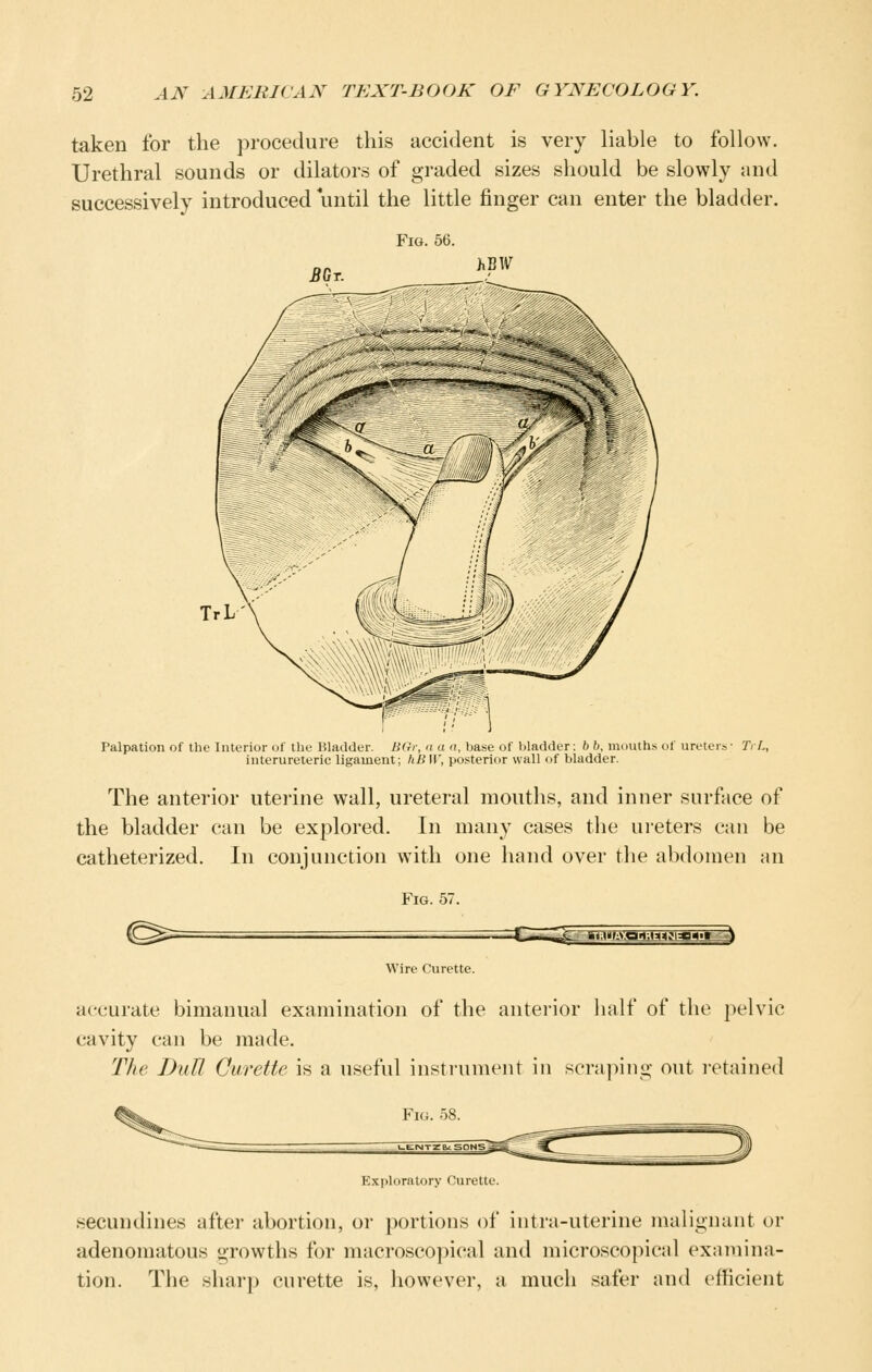 taken for the procedure this accident is very liable to follow. Urethral sounds or dilators of graded sizes should be slowly and successively introduced until the little finger can enter the bladder. Fig. 56. 3Gt. hBW TrL' Palpation of the Interior of tlie Bladder. BGr, d a a, base of bladder: 6 b, mouths of ureters- TrL, interureteric ligament; hB IC, posterior wall of bladder. The anterior uterine wall, ureteral mouths, and inner surface of the bladder can be explored. In many cases the ureters can be catheterized. In conjunction with one hand over tlie abdomen an Fig. 57. ^ :C«i*ia^i^^Pfl'iV-0'<-.»<Jl^j;lj-^.^ Wire Curette. accurate bimanual examination of the anterior half of the pelvic cavity can be made. The DuU Curette is a useful instrument iu scraping out retained Fig. 58. Exploratory Curette. secundines after abortion, or portions of intra-uterine malignant or adenomatous growths for macroscopical and microscopical examina- tion. The sharp curette is, however, a much safer and efficient