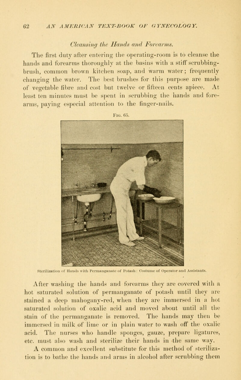 Cleansing the Hands and Forearms. The first duty after entering the operating-room is to cleanse the hands and forearms thoronglily at tlie basins with a stiff scrubbing- brush, common brown kitchen soap, and warm water; frequently changing the watei-. The best brushes for this purpose are made of vegetable fibre and cost but twelve or fifteen cents apiece. At least ten minutes must be spent in scrubbing tlie hands and fore- arms, paying especial attention to the finger-nails. Fig. 65. sterilization of Hand ume of Opurator and Assistants. After washing the hands and forearms they are covered with a hot saturated solution of permanganate of jiotash until they are stained a dee{) mahogany-red, when they are immersed in a hot saturated solution of oxalic acid and moved about until all the stain of the permanganate is removed. The hands may then be immersed in milk of lime or in plain water to wash off the oxalic acid. The nurses who handle sponges, gauze, prepare ligatui-es, etc. must also wash and sterilize their hands in the same way. A common and excellent substitute for this method of steriliza- tion is to bathe the hands and arms in alcohol after scrubbing- them