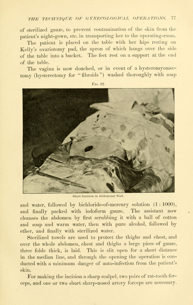 of sterilized gauze, to prevent contamination of the skin from the patient's night-gown, etc. in transporting her to the operating-room. The patient is placed on the table with her hips resting on Kelly's ovariotomy pad, the apron of which hangs over the side of the table into a bucket. The feet rest on a support at the end of the table. The vagina is now douched, or in event of a hysteromyomec- tomy (hysterectomy for  fibroids ) washed thoroughly with soap Fig. 82. liin^iMiL ill Ali^lMiuinal Wall. and water, followed by bichloride-of-mercury solution (1 : 1000), and finally packed with iodoform gauze. The assistant now cleanses the abdomen by first scrubbing it with a ball of cotton and soap and warm water, then with pure alcohol, followed by ether, and finally with sterilized water. Sterilized towels are used to protect the thighs and chest, and over the whole abdomen, chest and thighs a large piece of gauze, three folds thick, is laid. This is slit open for a short distance in the median line, and through the opening the operation is con- ducted with a minimum danger of auto-infection from the patient's skin. For making the incision a sharp scalpel, two pairs of rat-tooth for- ceps, and one or two short sharp-nosed artery forceps are necessary.