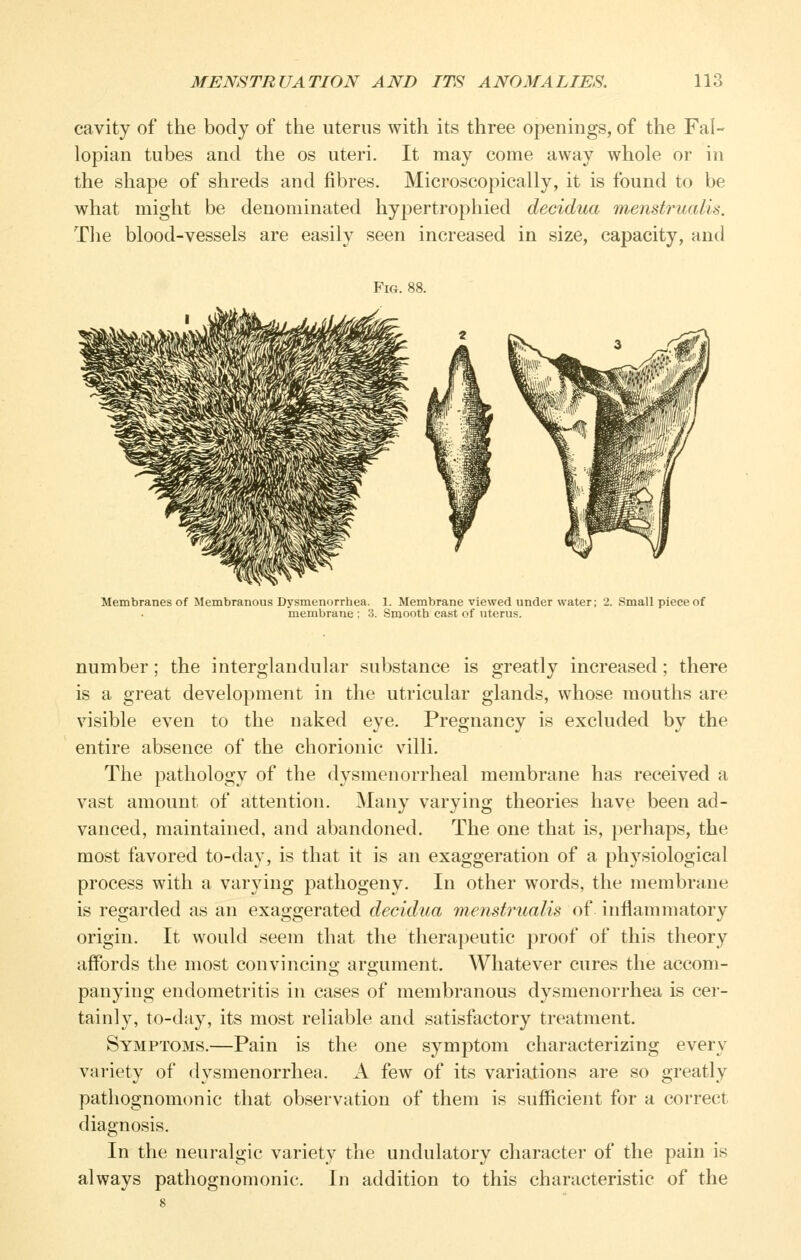 cavity of the body of the uterus with its three openings, of the Fal- lopian tubes and the os uteri. It may come away whole or in the shape of shreds and fibres. Microscopically, it is found to be what might be denominated hypertrophied decidua menstrualu. The blood-vessels are easily seen increased in size, capacity, and Membranes of Membranous Dysmenorrhea. 1. Membrane viewed under water; 2. Small piece of membrane : 3. Smooth cast of uterus. number; the interglandular substance is greatly increased ; there is a great development in the utricular glands, whose mouths are visible even to the naked eye. Pregnancy is excluded by the entire absence of the chorionic villi. The pathology of the dysmenorrheal membrane has received a vast amount of aittention. Many varying theories have been ad- vanced, maintained, and abandoned. The one that is, perhaps, the most favored to-day, is that it is an exaggeration of a physiological process with a varying pathogeny. In other words, the membrane is regarded as an exaggerated decidua menstrualis of inflammatory origin. It would seem that the therapeutic proof of this theory affords the most convincing argument. Whatever cures the accom- panying endometritis in cases of membranous dysmenorrhea is cer- tainly, to-day, its most reliable and satisfactory treatment. Symptoms.—Pain is the one symptom characterizing every variety of dysmenorrhea. A few of its variations are so greatly pathognomonic that observation of them is sufficient for a correct diagnosis. In the neuralgic variety the undulatory character of the pain is always pathognomonic. In addition to this characteristic of the