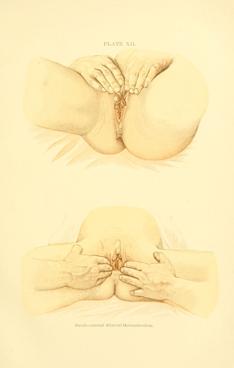 PLATE XII. / Pseudo-external Bilateral Hermapbrodism.