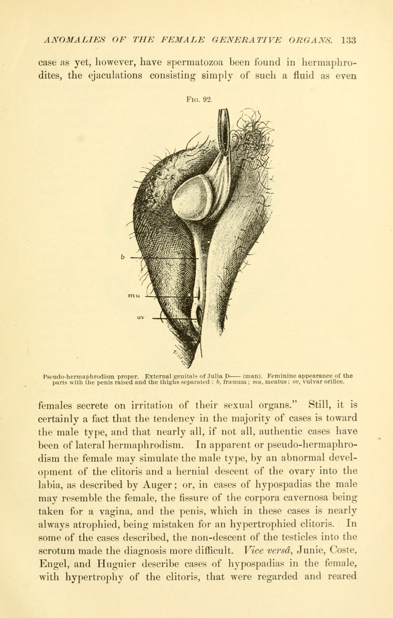 case as yet, however, have spermatozoa been found in hermaphro- dites, the ejaculations consisting simply of such a fluid as even Fig. 92. Pseudo-hermaphrodism proper. External genitals of Julia D (man). Feminine appearance of the parts with the penis raised and the thighs separated : 6, frsenum; mu, meatus; ov, vulvar orifice. females secrete on irritation of their sexual organs. Still, it is certainly a fact that the tendency in the majority of cases is toward the male type, and that nearly all, if not all, authentic cases have been of lateral hermaphrodism. In apparent or pseudo-hermaphro- dism the female may simulate the male type, by an abnormal devel- opment of the clitoris and a hernial descent of the ovary into the labia, as described by Auger; or, in cases of hypospadias the male may resemble the female, the fissure of the corpora cavernosa being taken for a vagina, and the penis, which in these cases is nearly always atrophied, being mistaken for an hypertrophied clitoris. In some of the cases described, the non-descent of the testicles into the scrotum made the diagnosis more difficult. Vice versa, Junie, Coste, Engel, and Huguier describe cases of hypospadias in the female, with hypertrophy of the clitoris, that were regarded and reared