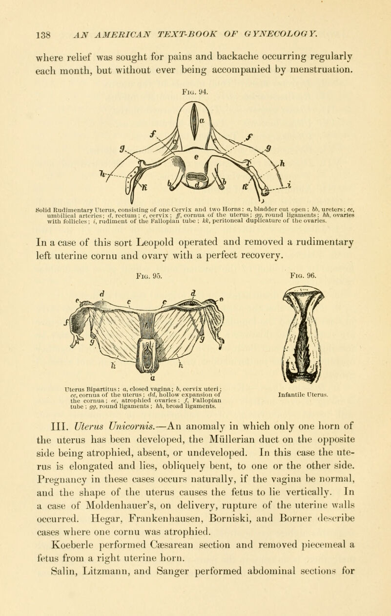 where relief was sought for pains and backache occurring regularly each month, but without ever being accompanied by menstruation. Fig. 94. Solid Rudimentary Uterus, consisting of one Cervix and two Horns: a, bladder cut open ; 66, ureters; cc, umbilical arteries; d, rectum; e, cervix; ff, cornua of the uterus; gg, round ligaments; hh, ovaries with follicles; i, rudiment of the Fallopiau tube ; kk, peritoneal duplicature of the ovaries. In a case of this sort Leopold operated and removed a rudimentary left uterine cornu and ovary with a perfect recovery. Fig. 95. YiQ. 96. Uterus Bipartilus: a, closed vagina; 6, cervix uteri; cc, cornua of the uterus ; dd, hollow expansion of the cornua; ee, atrophied ovaries; /, Fallopian tube ; gg, round ligaments ; hh, broad ligaments. Infantile Uterus. III. Uterus Unicornis.—An anomaly in which only one horn of the uterus has been developed, the Miillerian duct on the opposite side being atrophied, absent, or undeveloped. In this case the ute- rus is elongated and lies, obliquely bent, to one or the other side. Pregnancy in these cases occurs naturally, if the vagina be normal, and the shape of the uterus causes the fetus to lie vertically. In a case of Moldenhauer's, on delivery, rupture of the uterine walls occurred. Hegar, Frankenhausen, Borniski, and Borner doscribe cases where one cornu was atrophied. Koeberle performed Caesarean section and removed piecemeal a fetus from a right uterine horn. Salin, Litzmann, and Sanger performed abdominal sections for