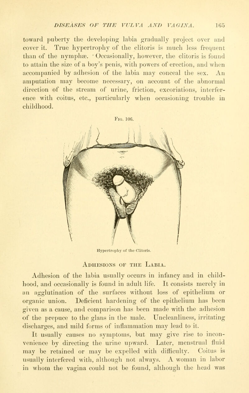 toward puberty the clevelopinoj labia gradually project over and cover it. True hypertrophy of the clitoris is much less frequent than of the nympliee. ' Occasionally, however, the clitoris is found to attain the size of a boy's penis, with powers of erection, and when accompanied by adhesion of the labia may conceal the sex. An amputation may become necessary, on account of the abnormal direction of the stream of urine, friction, excoriations, interfer- ence with coitus, etc., particularly when occasioning trouble in childhood. Fig. 106. Hypertrophy of the Clitoris. Adhesions of the Labia. Adhesion of the labia usually occurs in infancy and in child- hood, and occasionally is found in adult life. It consists merely in an agglutination of the surfaces without loss of epithelium or organic union. Deficient hardening of the epithelium has been given as a cause, and comparison has been made with the adhesion of the prepuce to the glans in the male. Uncleanliness, irritating discharges, and mild forms of inflammation may lead to it. It usually causes no symptoms, but may give rise to incon- venience by directing the urine upward. Later, menstrual fluid may be retained or may be expelled with difficulty. Coitus is usually interfered with, although not always. A woman in labor in whom the vasfina could not be found, although the head was