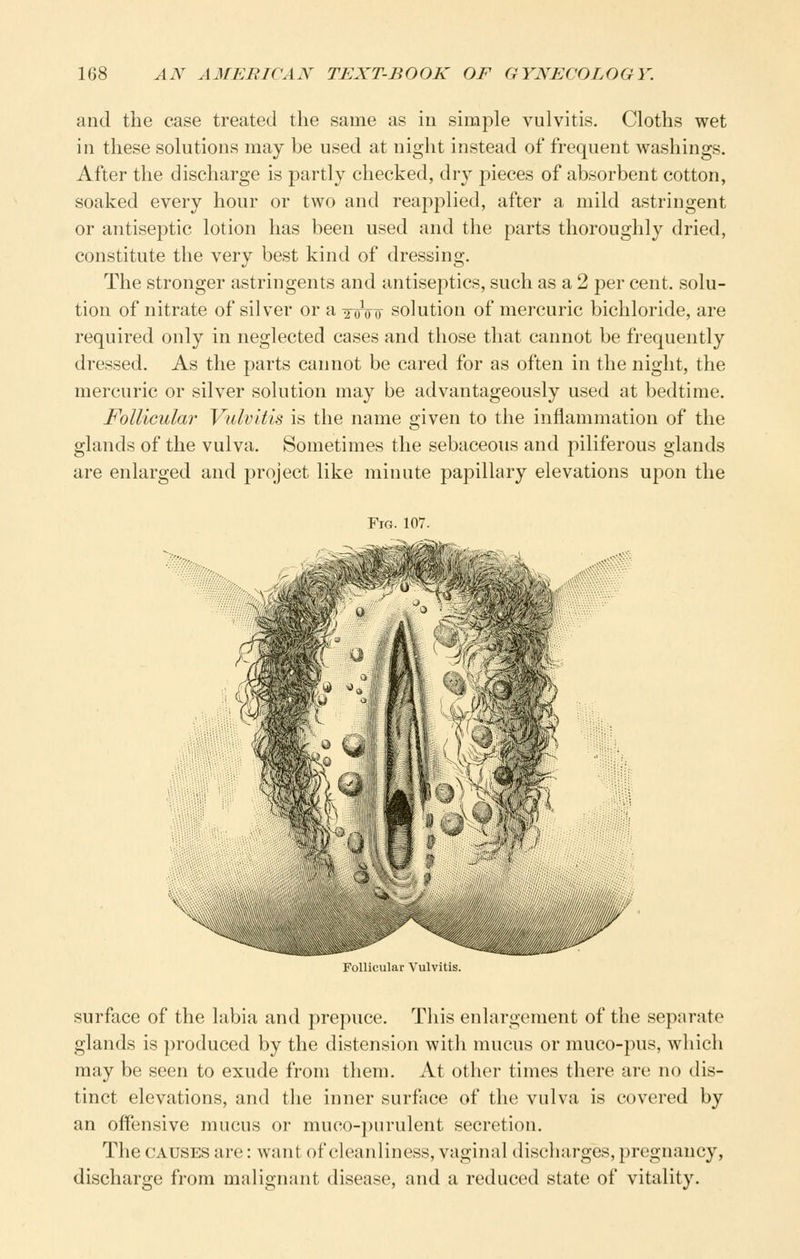 and the case treated the same as in simple vulvitis. Cloths wet in these solutions may be used at night instead of frequent washings. After the discharge is partly checked, dry pieces of absorbent cotton, soaked every hour or two and reapplied, after a mild astringent or antiseptic lotion has been used and the parts thoroughly dried, constitute the very best kind of dressing. The stronger astringents and antiseptics, such as a 2 per cent, solu- tion of nitrate of silver or a yoVo solution of mercuric bichloride, are required only in neglected cases and those that cannot be frequently dressed. As the parts cannot be cared for as often in the night, the mercuric or silver solution may be advantageously used at bedtime. Follicular Vulvitis is the name given to the inflammation of the glands of the vulva. Sometimes the sebaceous and piliferous glands are enlarged and project like minute papillary elevations upon the Fig. 107. Follicular Vulvitis. surface of the labia and prepuce. This enlargement of the separate glands is produced by the distension with mucus or muco-pus, which may be seen to exude from them. At other times there are no dis- tinct elevations, and the inner surface of the vulva is covered by an offensive mucus or muco-purulent secretion. The CAUSES are: want of cleanliness, vaginal discharges, pregnancy, discharge fi'om malignant disease, and a reduced state of vitality.