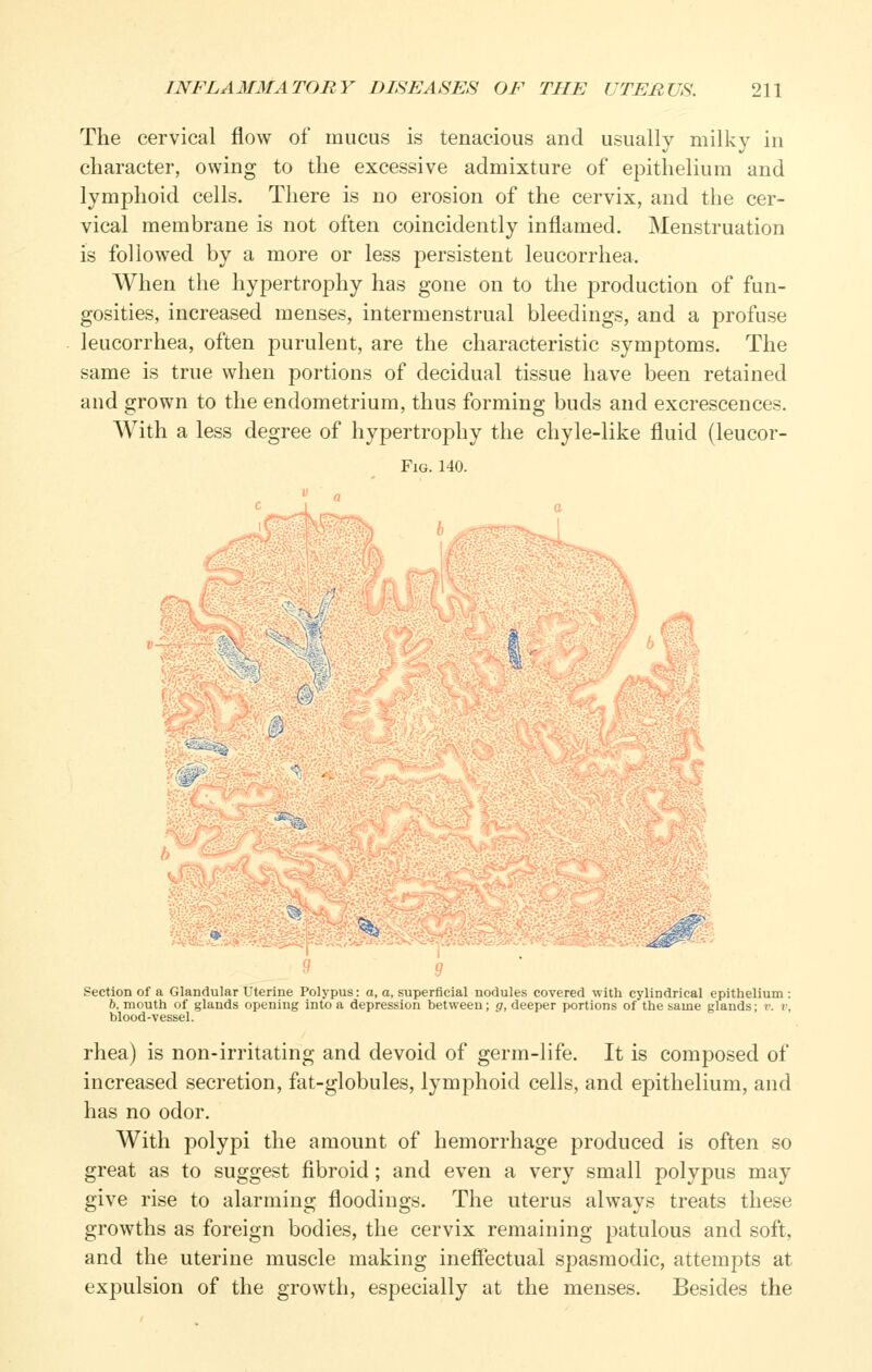 The cervical flow of mucus is tenacious and usually milky in character, owing to the excessive admixture of epithelium and lymphoid cells. There is no erosion of the cervix, and the cer- vical membrane is not often coincidently inflamed. Menstruation is followed by a more or less persistent leucorrhea. When the hypertrophy has gone on to the production of fun- gosities, increased menses, intermenstrual bleedings, and a profuse leucorrhea, often purulent, are the characteristic symptoms. The same is true when portions of decidual tissue have been retained and grown to the endometrium, thus forming buds and excrescences. With a less degree of hypertrophy the chyle-like fluid (leucor- FiG. 140.  a Section of a Glandular Uterine Polypus: a, a, superficial nodules covered with cylindrical epithelium : 6, mouth of glands opening into a depression between; g, deeper portions of the same glands; v. v, hlood-vessel. rhea) is non-irritating and devoid of germ-life. It is composed of increased secretion, fat-globules, lymphoid cells, and epithelium, and has no odor. With polypi the amount of hemorrhage produced is often so great as to suggest fibroid; and even a very small polypus may give rise to alarming floodings. The uterus always treats these growths as foreign bodies, the cervix remaining patulous and soft, and the uterine muscle making ineffectual spasmodic, attempts at expulsion of the growth, especially at the menses. Besides the