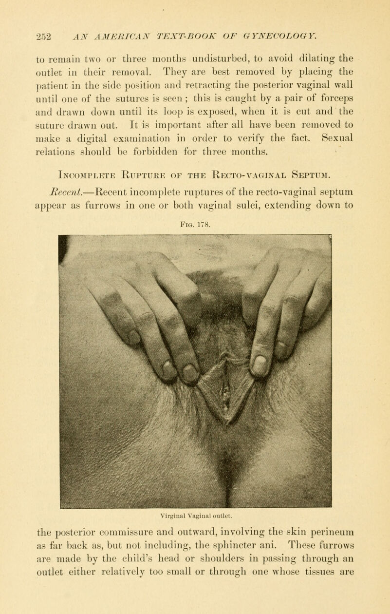 to remain two or three months undisturbed, to avoid dilating the outlet in their removal. They are best removed by placing the patient in the side position and retracting the posterior vaginal wall until one of the sutures is seen; this is caught by a pair of forceps and drawn down until its loop is exposed, when it is cut and the suture drawn out. It is important after all have been removed to make a digital examination in order to verify the fact. Sexual relations should be forbidden for three months. Incomplete Kupture of the Recto-vaginal Septum. Recent.—Recent incomplete ruptures of the recto-vaginal septum appear as furrows in one or both vaginal sulci, extending down to Fig. 178. f 'I w Virginal Vaginal outlet. the posterior commissure and outward, involving the skin perineum as far back as, but not including, the sphincter ani. These furrows are made by the child's head or shoulders in passing through an outlet either relatively too small or through one whose tissues are