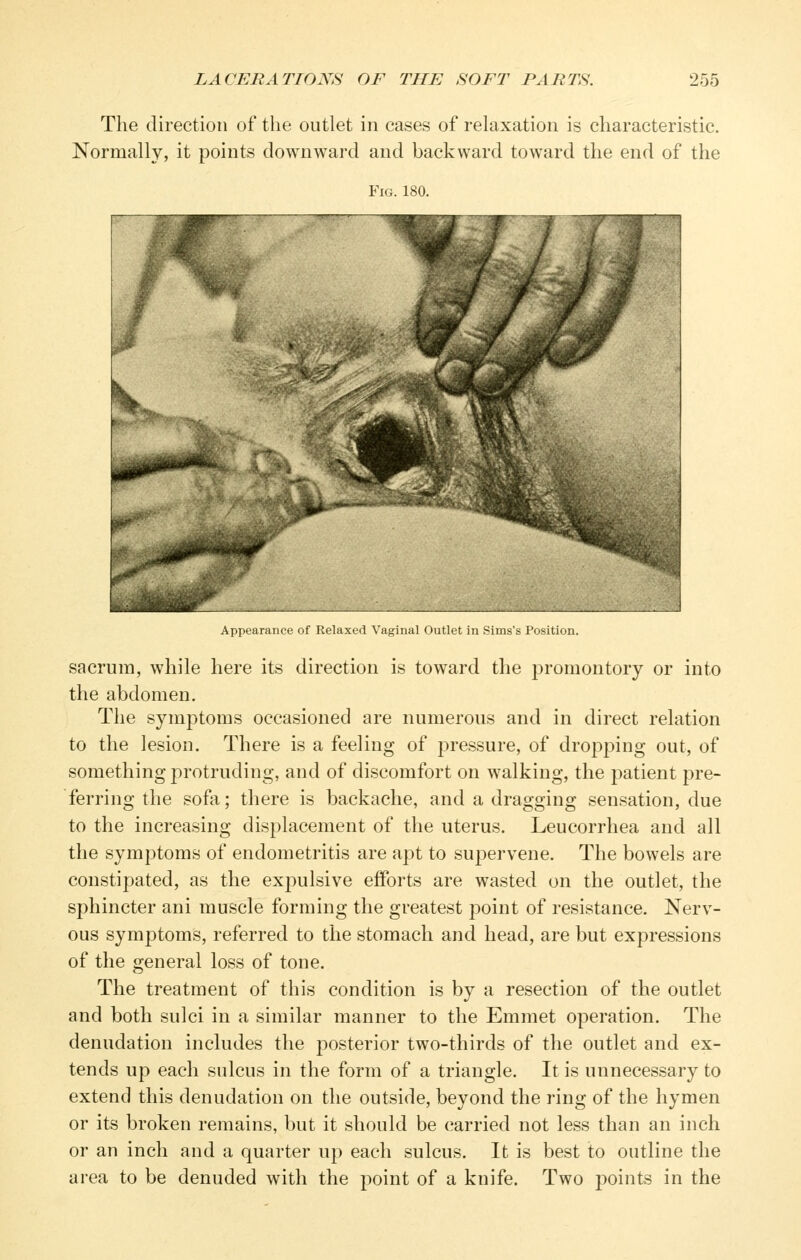 The direction of the outlet in cases of rekixation is characteristic. Normally, it points downward and backward toward the end of the Fig. 180. ^^^^^^^B Appearance of Relaxed Vaginal Outlet in Sims's Position. sacrum, while here its direction is toward the promontory or into the abdomen. The symptoms occasioned are numerous and in direct relation to the lesion. There is a feeling of pressure, of dropping out, of something protruding, and of discomfort on walking, the patient pre- ferring the sofa; there is backache, and a dragging sensation, due to the increasing displacement of the uterus. Leucorrhea and all the symptoms of endometritis are apt to supervene. The bowels are constipated, as the expulsive efforts are wasted on the outlet, the sphincter ani muscle forming the greatest point of resistance. Nerv- ous symptoms, referred to the stomach and head, are but expressions of the general loss of tone. The treatment of this condition is by a resection of the outlet and both sulci in a similar manner to the Emmet operation. The denudation includes the posterior two-thirds of the outlet and ex- tends up each sulcus in the form of a triangle. It is unnecessary to extend this denudation on the outside, beyond the ring of the hymen or its broken remains, but it should be carried not less than an inch or an inch and a quarter up each sulcus. It is best to outline the area to be denuded with the point of a knife. Two points in the