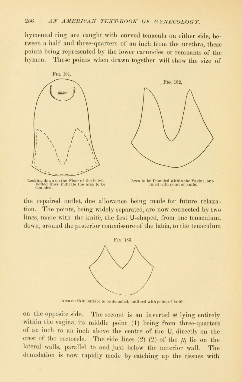 hymeneal ring are caught with curved tenacula on either side, be- tween a half and three-quarters of an inch from the urethra, these points being represented by the lower caruncles or remnants of the hymen. These points when drawn together will show the size of Fig. 181. Looking down on the Floor of the Pelvis. Dotted lines indicate the area to be denuded. Fig. 182, Area to be Denuded within the Vagina, out- lined with point of knife. the repaired outlet, due allowance being made for future relaxa- tion. The points, being widely separated, are now connected by two lines, made with the knife, the first U-shaped, from one tenaculum, down, around the posterior commissure of the labia, to the tenaculum Area on Skin Surface to be denuded, outlined with point of knife. on the opposite side. The second is an inverted M lying entirely within the vagina, its middle point (1) being from tiiree-quarters of an inch to an inch above the centre of the U, directly on the crest of the rectocele. Tiie side lines (2) (2) of the M lie on the lateral walls, parallel to and just below the anterior wall. The denudation is now rapidly made by catching up the tissues with