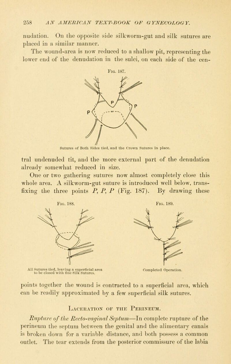 nudation. On the opposite side silkworm-gut and silk sutures are placed in a similar manner. The wound-area is now reduced to a shallow pit, representing the lower end of the denudation in the sulci, on each side of the cen- FiG. 187. Sutures of Both Sides tied, and the Crown Sutures in place. tral undenuded tit, and the more external part of the denudation already somewhat reduced in size. One or two gathering sutures now almost completely close this whole area. A silkworm-gut suture is introduced well below, trans- fixing the three points P, P, P (Fig. 187). By drawing these Fig. 188. Fig. 189. All Sutures tied, leaving a superficial area to be closed with fine Silk Sutures. Completed Operation. points together the wound is contracted to a superficial area, which can be readily approximated by a few superficial silk sutures. Laceration of the Perineum. Rupture of the Recto-vaginal Septum—In complete rupture of the perineum the septum between the genital and the alimentary canals is broken down for a variable distance, and both possess a common outlet. The tear extends from the posterior commissure of the labia