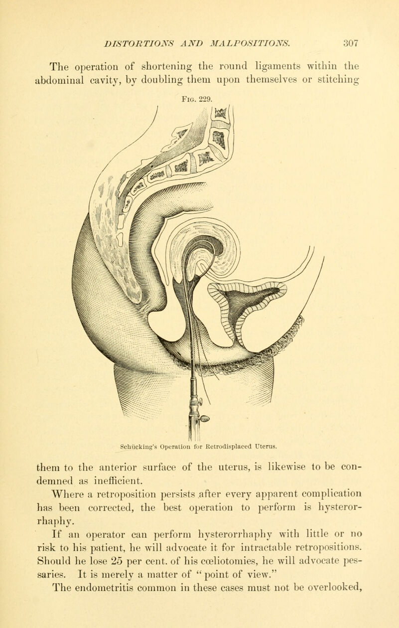 The operation of shortening the round ligaments within the abdominal cavity, by doubling them upon themselves or stitching Fig. 229. Schiicking's Operation for Retrodisplaced Uterus. them to the anterior surface of the uterus, is likewise to be con- demned as inefficient. Where a retroposition persists after every apparent complication has been corrected, the best operation to perform is hysteror- rhaphy. If an operator can perform hysterorrhaphy with little or no risk to his patient, he will advocate it for intractable retropositions. Should he lose 25 per cent, of his coeliotomies, he will advocate pes- saries. It is merely a matter of '' point of view. The endometritis common in these cases must not be overlooked,