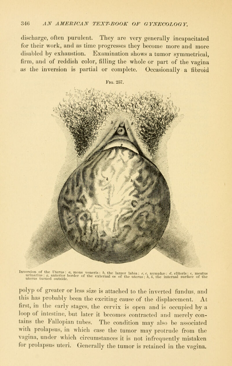 discharge, often purulent. They are very generally incapacitated for their work, and as time progresses they become more and more disabled by exhaustion. Examination shows a tumor symmetrical, firm, and of reddish color, filling the whole or part of the vagina as the inversion is partial or complete. Occasionally a fibroid Fig. 257. ^rnVnunl! ' /^tcrus : «, mons Veneris; b, the larger labia: c,c, nymphs; d. clitoris: e, meatus ut.iu' tmiu^routM^de ^^ ^^ external os of the uterus; h, il, the internal surface of the polyp of greater or less size is attached to the inverted fundus, and this has probably been the exciting cause of the displacement. At first, in the early stages, the cervix is open and is occupied by a loop of intestine, but later it becomes contracted and merely con- tains the Fallopian tubes. The condition may also be associated with prolapsus, in which case the tumor may ]irotrude from the vagina, under which circumstances it is not infrequently mistaken for prolapsus uteri. Generally the tumor is retained in the vagina.