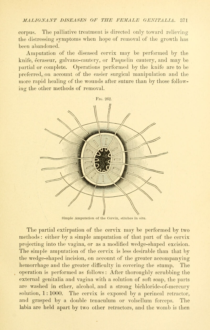 corpus. The palliative treatment is directed only toward relieving the distressing symptoms when hope of removal of the growth has been abandoned. Amputation of the diseased cervix may be performed by the knife, ecraseur, galvano-cautery, or Paquelin cautery, and may be partial or complete. Operations performed by the knife are to be preferred, on account of the easier surgical manipulation and the more rapid healing of the wounds after suture than by those follow- ing the other methods of removal. Simple Amputation of the Cervix, stitches in situ. The partial extirpation of the cervix may be performed by two methods: either by a simple amputation of that part of the cervix projecting into the vagina, or as a modified wedge-shaped excision. The simple amputation of the cervix is less desirable than that by the wedge-shaped incision, on account of the greater accomj^anying hemorrhage and the greater difficulty in covering the stump. The operation is performed as follows : After thoroughly scrubbing the external genitalia and vagina with a solution of soft soap, the parts are washed in ether, alcohol, and a strong bichloride-of-mercury solution, 1: 1000. The cervix is exposed by a perineal retractor, and grasped by a double tenaculum or volsellum forceps. The labia are held apart by two other retractors, and the womb is then