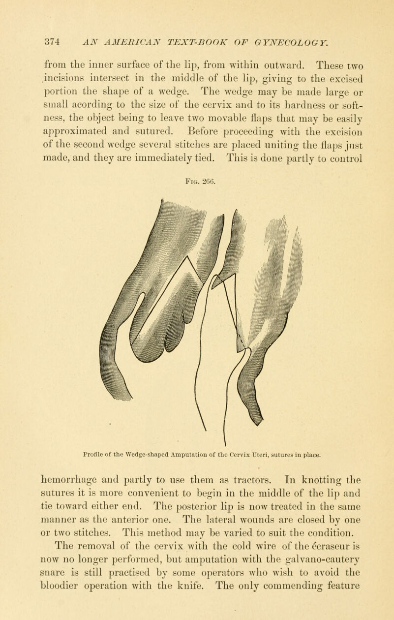 from the inner surface of the lip, from within outward. These two .incisions intersect in the middle of the lip, giving to the excised portion the shape of a wedge. The wedge may be made large or small acording to the size of the cervix and to its hardness or soft- ness, the object being to leave two movable flaps that may be easily approximated and sutured. Before proceeding with the excision of the second wedge several stitches are placed uniting the flaps just made, and they are immediately tied. This is done partly to control Fig. 266. Profile of the Wedge-shaped Amputation of the Cervix Uteri, sutures in place. hemorrhage and partly to use them as tractors. In knotting the sutures it is more convenient to begin in the middle of the lip and tie toward either end. The posterior lip is now treated in the same manner as the anterior one. The lateral wounds are closed by one or two stitches. This method may be varied to suit the condition. The removal of the cervix with the cold wire of the ^craseur is now no longer performed, but amputation with the galvano-cautery snare is still practised by some operators who wish to avoid the bloodier operation with the knife. The only commending feature