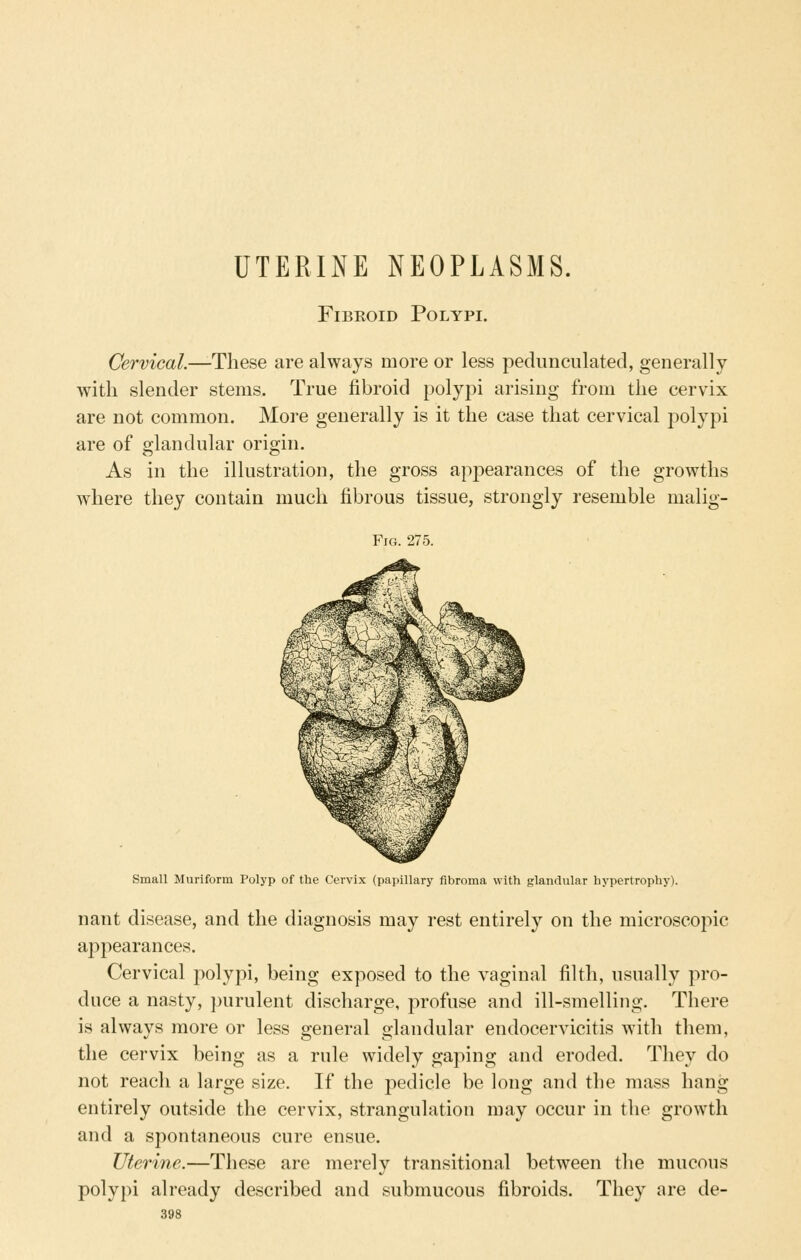 UTERINE NEOPLASMS. FiBKOiD Polypi. Cervical.—-These are always more or less pedunculated, generally with slender stems. True fibroid polypi arising from the cervix are not common. More generally is it the case that cervical polypi are of glandular origin. As in the illustration, the gross apj^earances of the growths where they contain much fibrous tissue, strongly resemble nialig- Small Muriform Polyp of the Cervix (papillary fibroma with glandular hypertrophy). nant disease, and the diagnosis may rest entirely on the microscopic appearances. Cervical polypi, being exposed to the vaginal filth, usually pro- duce a nasty, purulent discharge, profuse and ill-smelling. There is always more or less general glandular endocervicitis with them, the cervix being as a rule widely gaping and eroded. They do not reach a large size. If the pedicle be long and the mass hang entirely outside the cervix, strangulation may occur in the growth and a spontaneous cure ensue. Uterine.—These are merely transitional between the mucous polypi already described and submucous fibroids. They are de-