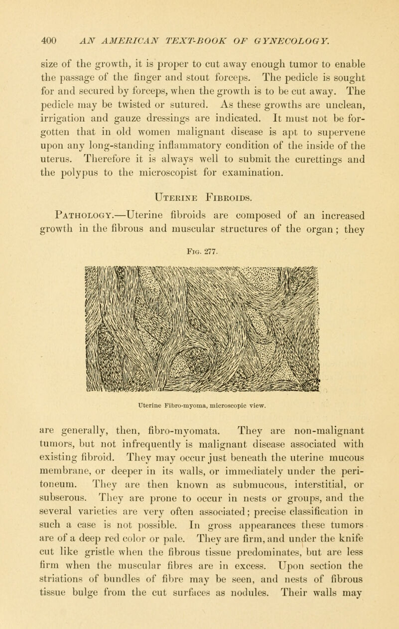 size of the growth, it is proper to cut away enough tumor to enable the passage of the finger and stout forceps. The pedicle is sought for and secured by forceps, when the growth is to be cut away. The pedicle may be twisted or sutured. As these growths are unclean, irrigation and gauze dressings are indicated. It must not be for- gotten that in old women malignant disease is apt to supervene upon any long-standing inflammatory condition of the inside of the uterus. Therefore it is always well to submit the curettings and the polypus to the microscoiDist for examination. Uterine Fibroids. Pathology.—Uterine fibroids are composed of an increased growth in the fibrous and muscular structures of the organ; they Fig. 277. Uterine Fibro-myoma, microscopic view. are generally, then, fibro-myomata. They are non-malignant tumors, but not infrequently is malignant disease associated with existing fibroid. They may occur just beneath the uterine mucous membrane, or deeper in its walls, or immediately under the peri- toneum. They are then known as submucous, interstitial, or subserous. They are prone to occur in nests or groups, and the several varieties are very often associated; precise classification in such a case is not possible. In gross appearances these tumors are of a deep red color or pale. They are firm, and under the knife cut like gristle wlien the fibrous tissue predominates, but are less firm when the muscular fibres are in excess. Upon section the striations of bundles of fibre may be seen, and nests of fibrous tissue bulge from the cut surfiices as nodules. Their walls may