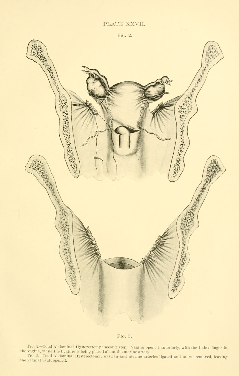 Fig. 2. Fig. 3. Fig. 2.—Total Abdominal Hysterectomy: second step. Vagina opened anteriorly, with the index finger in the vagina, while the ligature is being placed about the uterine artery. Fig. 3.—Total Abdominal Hysterectomy: ovarian and uterine arteries ligated and uterus removed, leaving the vaginal vault opened.