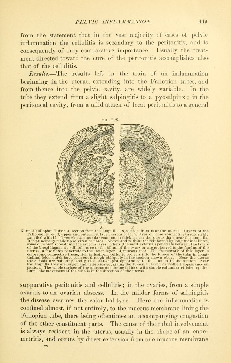 from the statement that in the vast majority of cases of pelvic inflammation the cellulitis is secondary to the peritonitis, and is consequently of only comparative importance. Usually the treat- ment directed toward the cure of the peritonitis accomplishes also that of the cellulitis. Results.—The results left in the train of an inflammation beginning in the uterus, extending into the Fallopian tubes, and from thence into the pelvic cavity, are widely variable. In the tube they extend from a slight salpingitis to a pyosalpinx ; in the peritoneal cavity, fi-om a mild attack of local peritonitis to a general Fig. 298. Normal Fallopian Tube : A, section from the ampulla ; B, section from near the uterus. Layers of the Fallopian tube : 1, upper and outermost layer, serous coat; 2, layer of loose connective tissue, richly oapplied with blood-vessels; 3. muscular coat, much thicker near the uterus than near the ampulla. It is principally made up of circular fibres. Above and within it is reinforced by longitudinal fibres, some of which spread into the mucous layer; others (the most external) penetrate between the layers of the broad ligament; still others go to the hilum of the ovary or are prolonged to the fundus ofthe uterus; a few fibres penetrate to the inner layer. 4, mucous coat. The framework of this layer is embryonic connective tissue, rich in fusiform cells; it projects into the lumen of the tube in longi- tudinal folds which have been cut through obliquely in the section shown above. Near the uterus these folds are radiating, and give a star-shaped appearance to the lumen in the section. Near the ampulla they are longer and reduplicated, giving the lumen a jagged or toothed appearance on section. The whole surface of the mucous membrane is lined with simple columnar ciliated epithe- lium ; the movement of the cilia is in the direction of the uterus. suppurative peritonitis and cellulitis; in the ovaries, from a simple ovaritis to an ovarian abscess. In the milder forms of salpingitis the disease assumes the catarrhal type. Here the inflammation is confined almost, if not entirely, to the mucous membrane lining the Fallopian tube, there being oftentimes an accompanying congestion of the other constituent parts. The cause of the tubal involvement is always resident in the uterus, usually in the shape of an endo- metritis, and occurs by direct extension from one mucous membrane 29