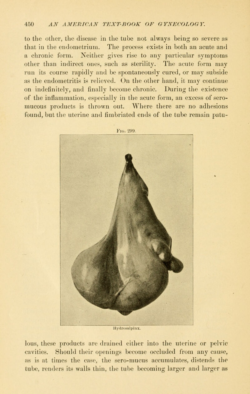 to the other, the disease in the tube not always being so severe as that in the endometrium. The process exists in both an acute and a chronic form. Neither gives rise to any particular symptoms other than indirect ones, such as steriHty. The acute form may run its course rapidly and be spontaneously cured, or may subside as the endometritis is relieved. On the other hand, it may continue on indefinitely, and finally become chronic. During the existence of the inflammation, especially in the acute form, an excess of sero- mucous products is thrown out. Where there are no adhesions found, but the uterine and fimbriated ends of the tube remain patu- Fig. 299. \ ^k L j^^^M ^ L ^ r Hydrosalpinx. lous, these products are drained either into the uterine or pelvic cavities. Should their openings become occluded from any cause, as is at times the case, the sero-mucus accumulates, distends the tube, renders its walls thin, the tube becomins; laroer and lars-er as