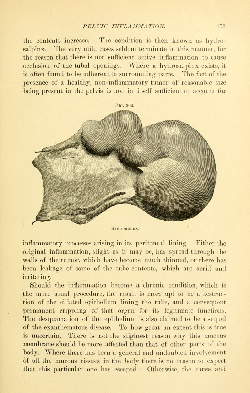 the contents increase. The condition is then known as hydro- salpinx. The very mild cases seldom terminate in this manner, for the reason that there is not sufficient active inflammation to cause occlusion of the tubal openings. Where a hydrosalpinx exists, it is often found to be adherent to surrounding parts. The fact of the presence of a healthy, non-inflammatory tumor of reasonable size being present in the pelvis is not in itself sufficient to account for Fig. 300. Hydrosalpinx. inflammatory processes arising in its peritoneal lining. Either the original inflammation, slight as it may be, has spread through the walls of the tumor, which have become much thinned, or there has been leakao;e of some of the tube-contents, which are acrid and Should the inflammation become a chronic condition, which is the more usual procedure, the result is more apt to be a destruc- tion of the ciliated epithelium lining the tube, and a consequent permanent crippling of that organ for its legitimate functions. The desquamation of the epithelium is also claimed to be a sequel of the exanthematous disease. To how great an extent this is true is uncertain. There is not the slightest reason why this mucous membrane should be more afl*ected than that of other parts of the body. Where there has been a general and undoubted involvement of all the mucous tissues in the body there is no reason to expect that this particular one has escaped. Otherwise, the cause and