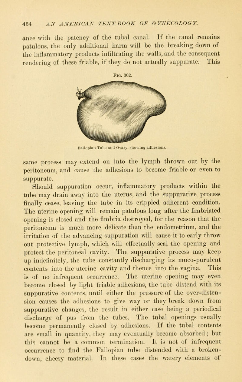 ance with the patency of the tubal canal. If tlie canal remains patulous, the only additional harm will be the breaking down of the inflammatory products infiltrating the walls, and the consequent rendering of these friable, if they do not actually suppurate. This Fig. 302. Fallopian Tube and Ovary, showing adhesions. same process may extend on into the lymph thrown out by the peritoneum, and cause the adhesions to become friable or even to suppurate. Should suppuration occur, inflammatory products within the tube may drain away into the uterus, and the suppurative process finally cease, leaving the tube in its crippled adherent condition. The uterine opening will remain patulous long after the fimbriated opening is closed and the fimbria destroyed, for the reason that the peritoneum is much more delicate than the endometrium, and the irritation of the advancing suppuration will cause it to early throw out protective lymph, which will effectually seal the opening and protect the peritoneal cavity. The suppurative process may keep up indefinitely, the tube constantly discharging its muco-purulent contents into the uterine cavity and thence into the vagina. This is of no infrequent occurrence. The uterine opening may even become closed by light friable adhesions, the tube distend with its suppurative contents, until either the pressure of the over-disten- sion causes the adhesions to give way or they break down from suppurative changes, the result in either case being a periodical discharge of pus from the tubes. The tubal openings usually become permanently closed by adhesions. If the tubal contents are small in quantity, they may eventually become absorbed; but this cannot be a common termination. It is not of infrequent occurrence to find the Fallopian tube distended with a broken- down, cheesy material. In these cases the watery elements of